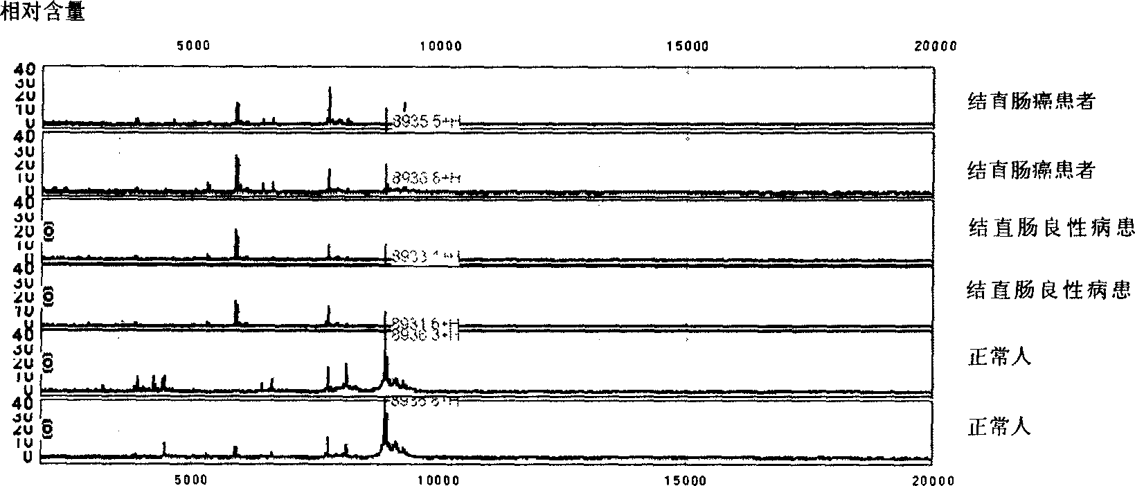 Use of protein fingerprint method in detecting protein fingerprint of colon cancer and rectum cancer in blood