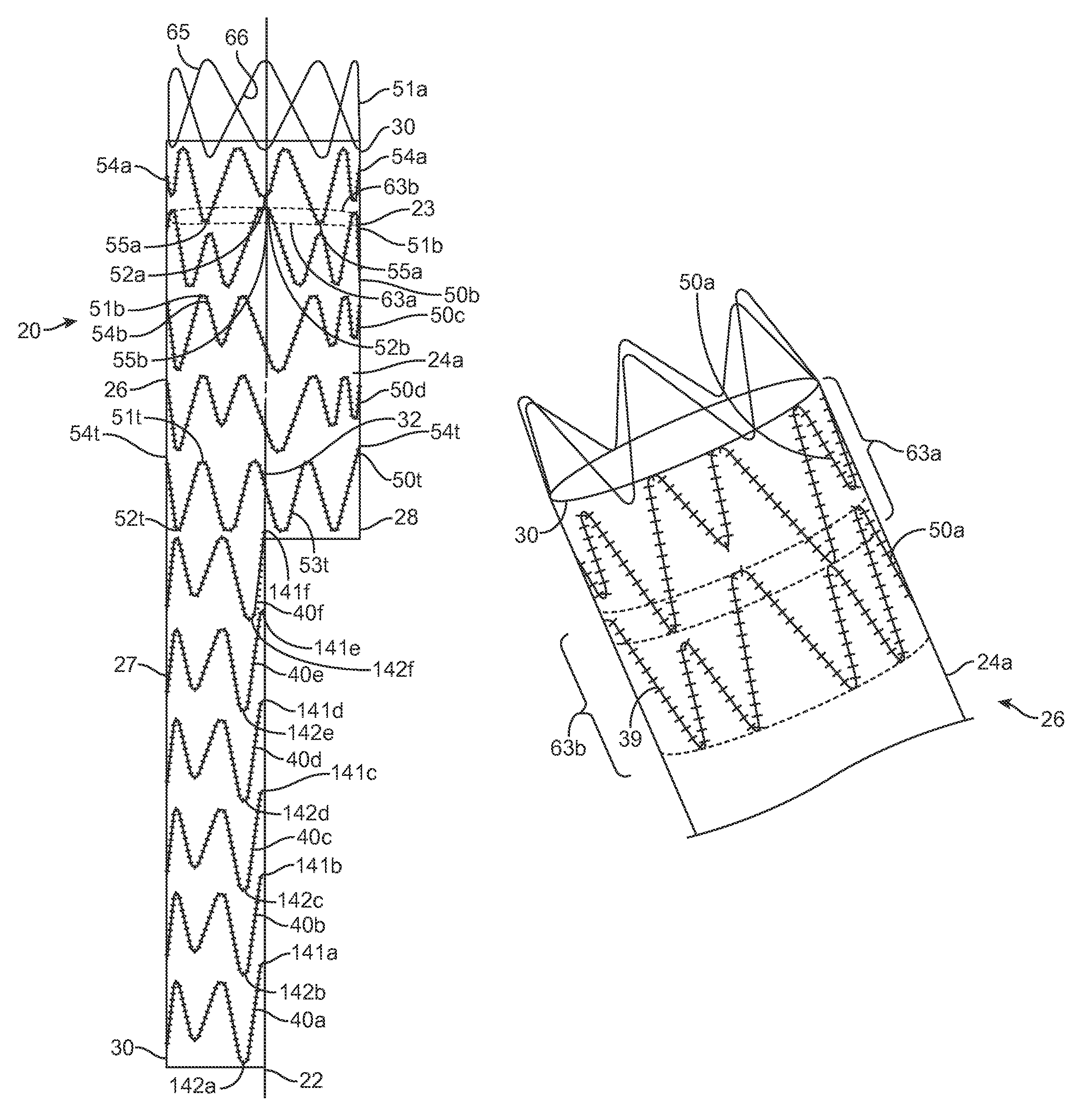 Endoluminal prosthesis