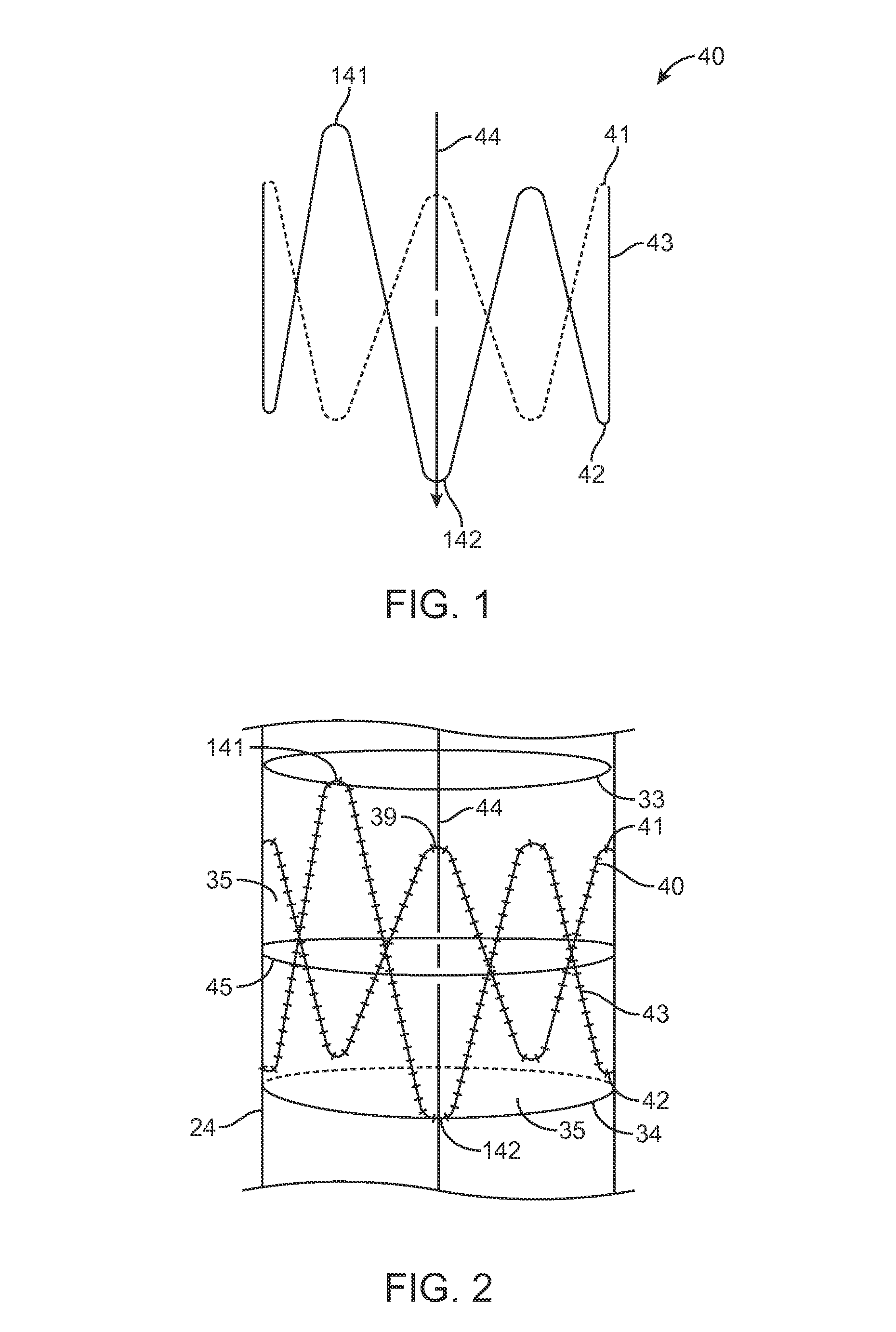 Endoluminal prosthesis