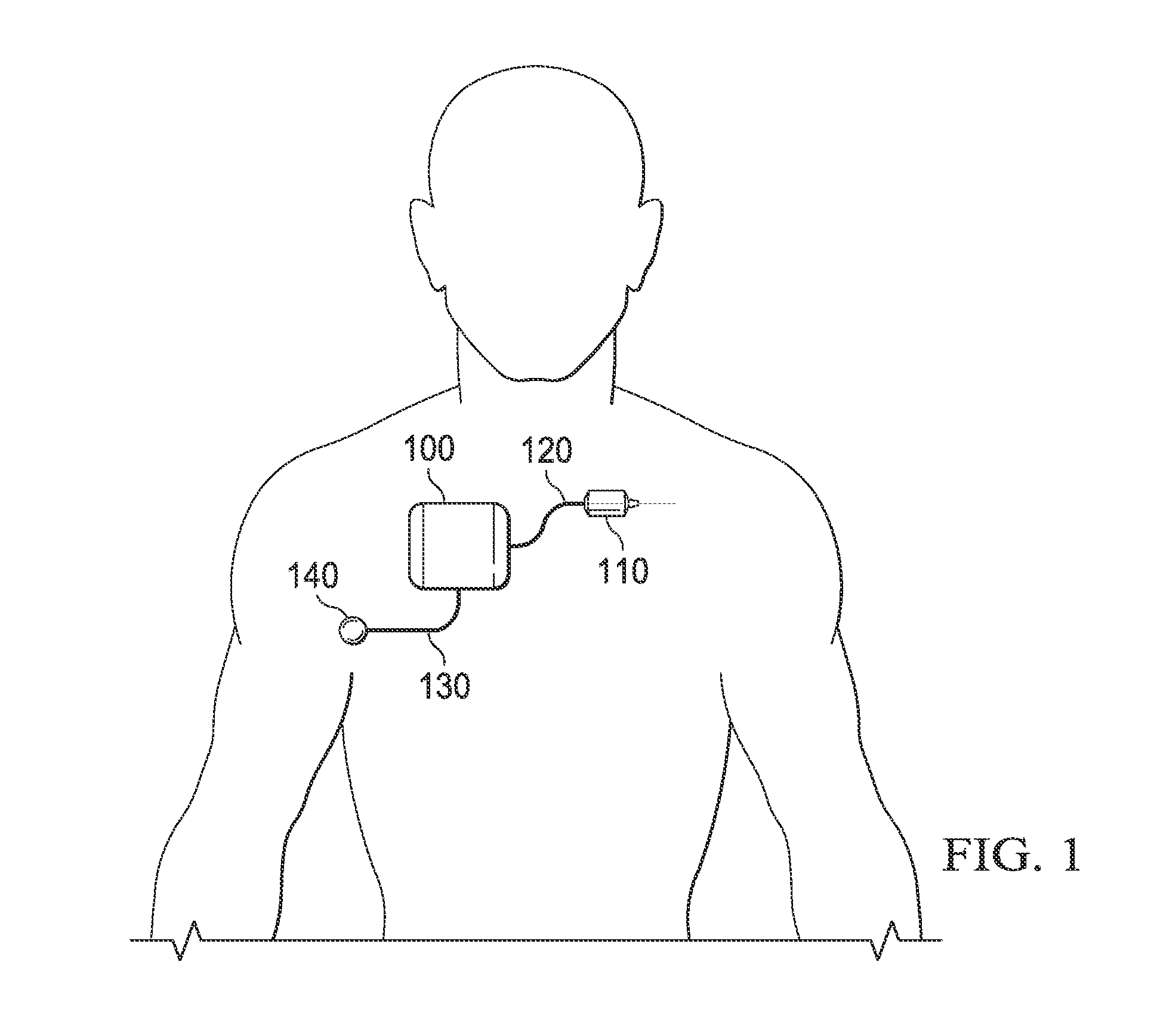 Method, apparatus and system for automatic treatment of pain