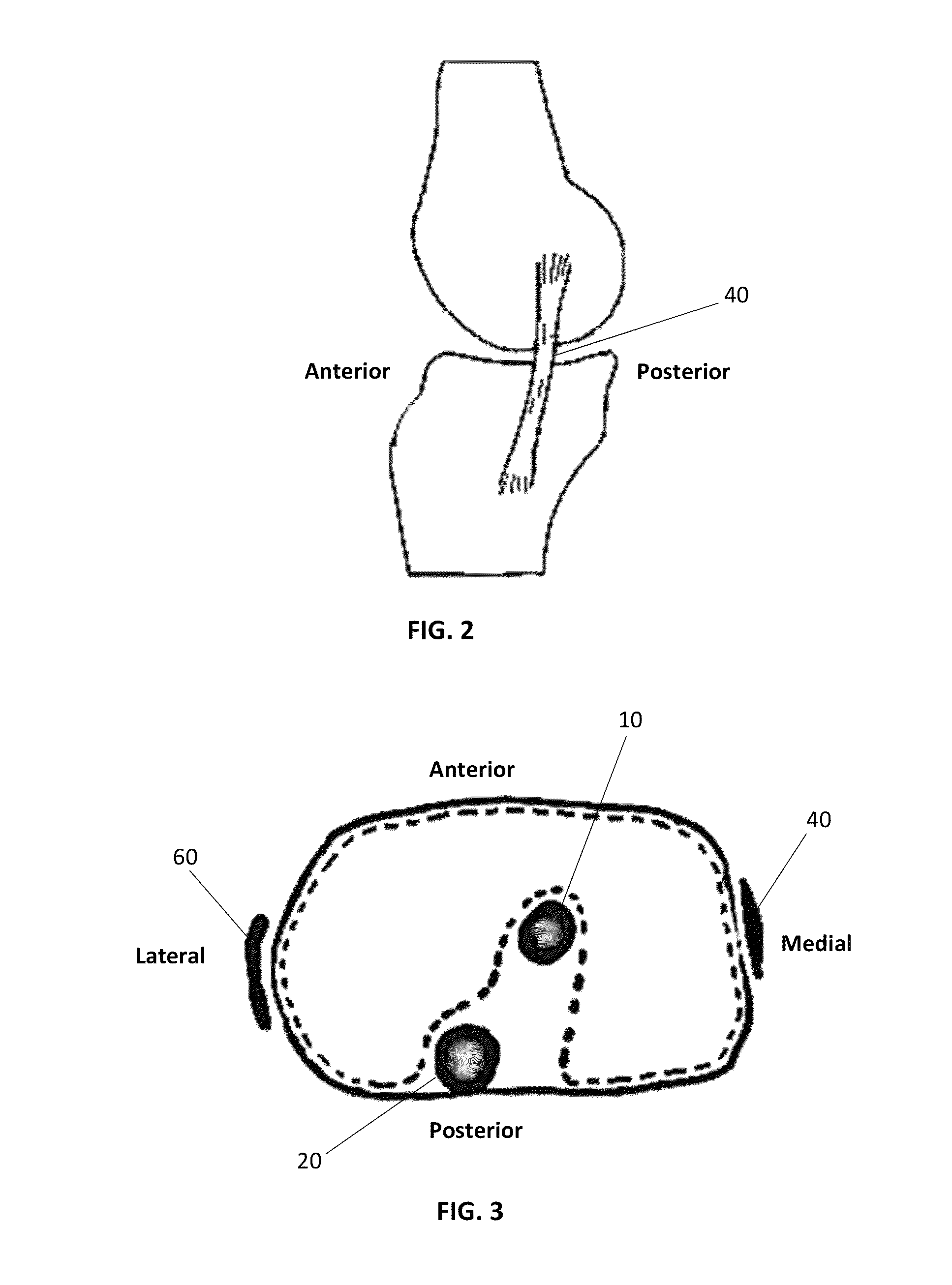 Patient specific soft tissue protectors and retractors