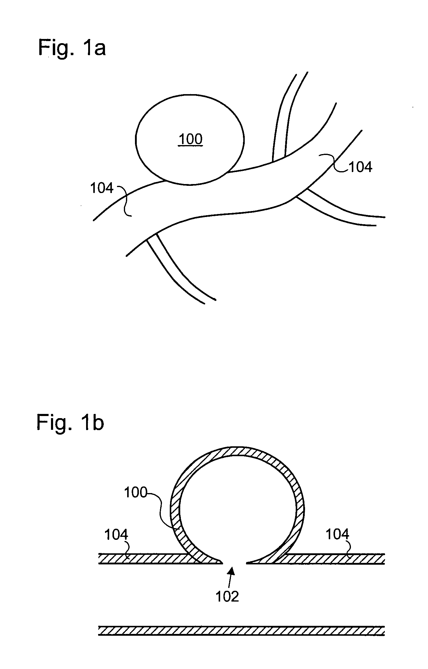 Balloon assisted occlusion of aneurysms