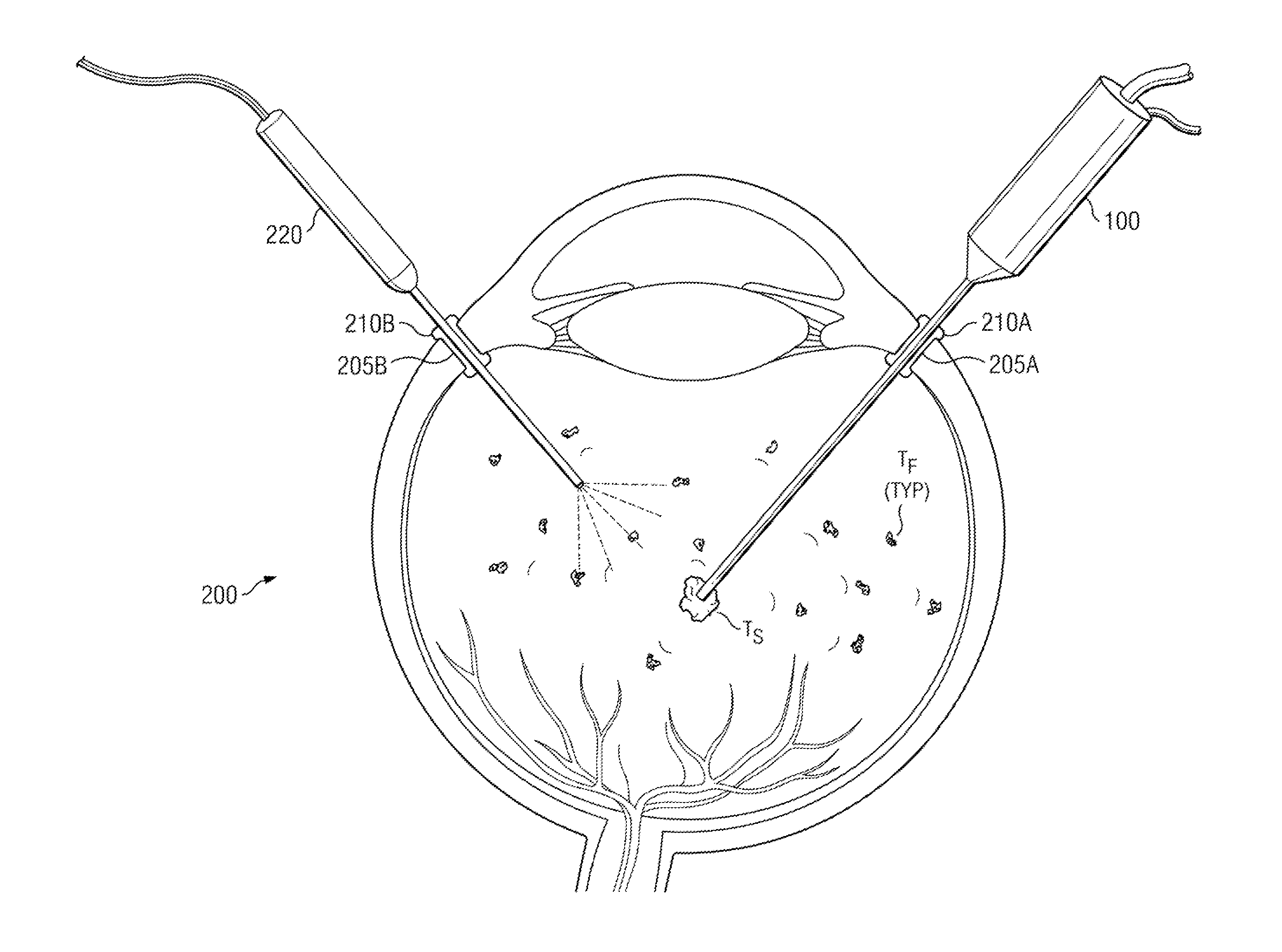 Small diameter fragmatome for minimally traumatic retained lens fragments removal