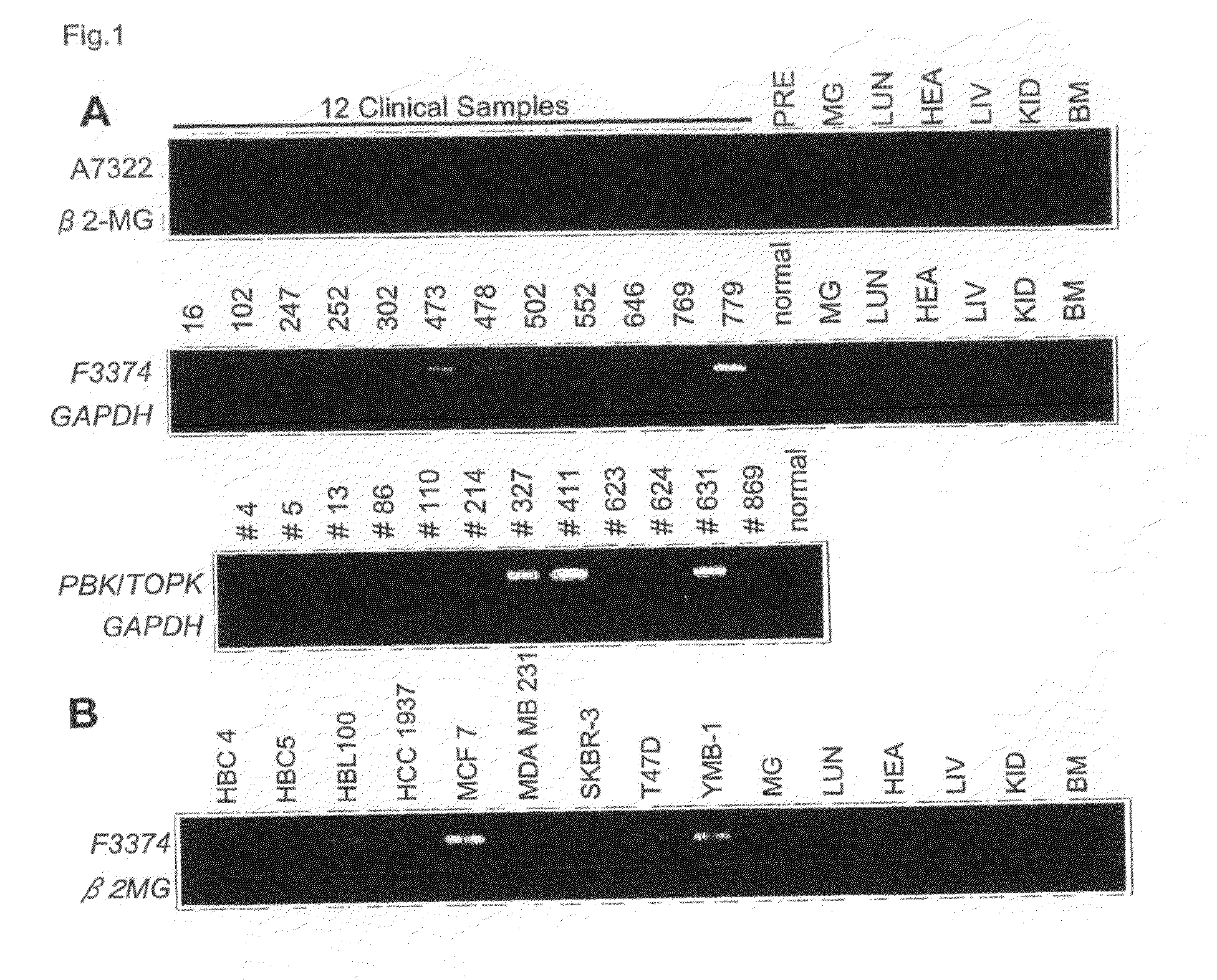 Genes and polypeptides relating to breast cancers