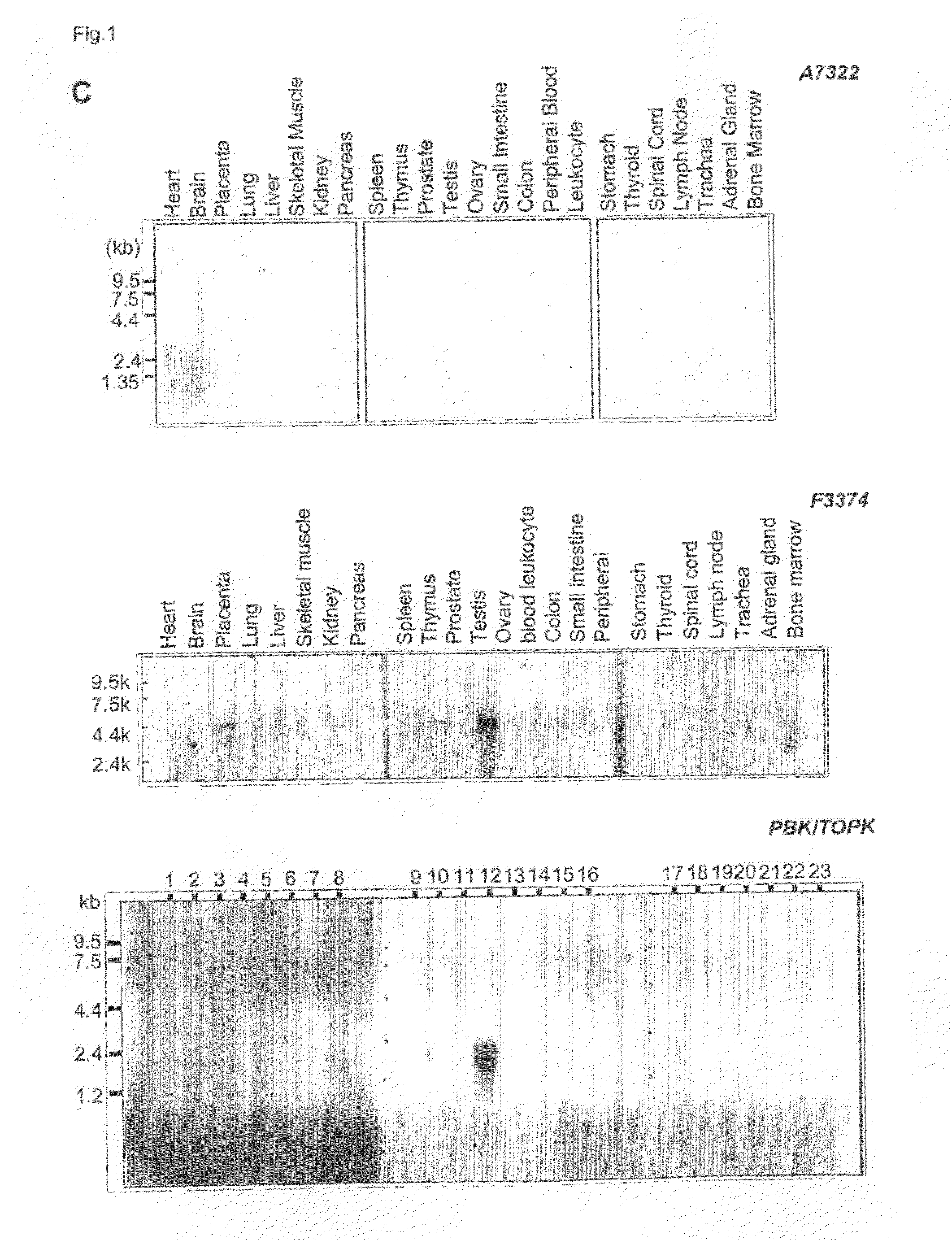 Genes and polypeptides relating to breast cancers