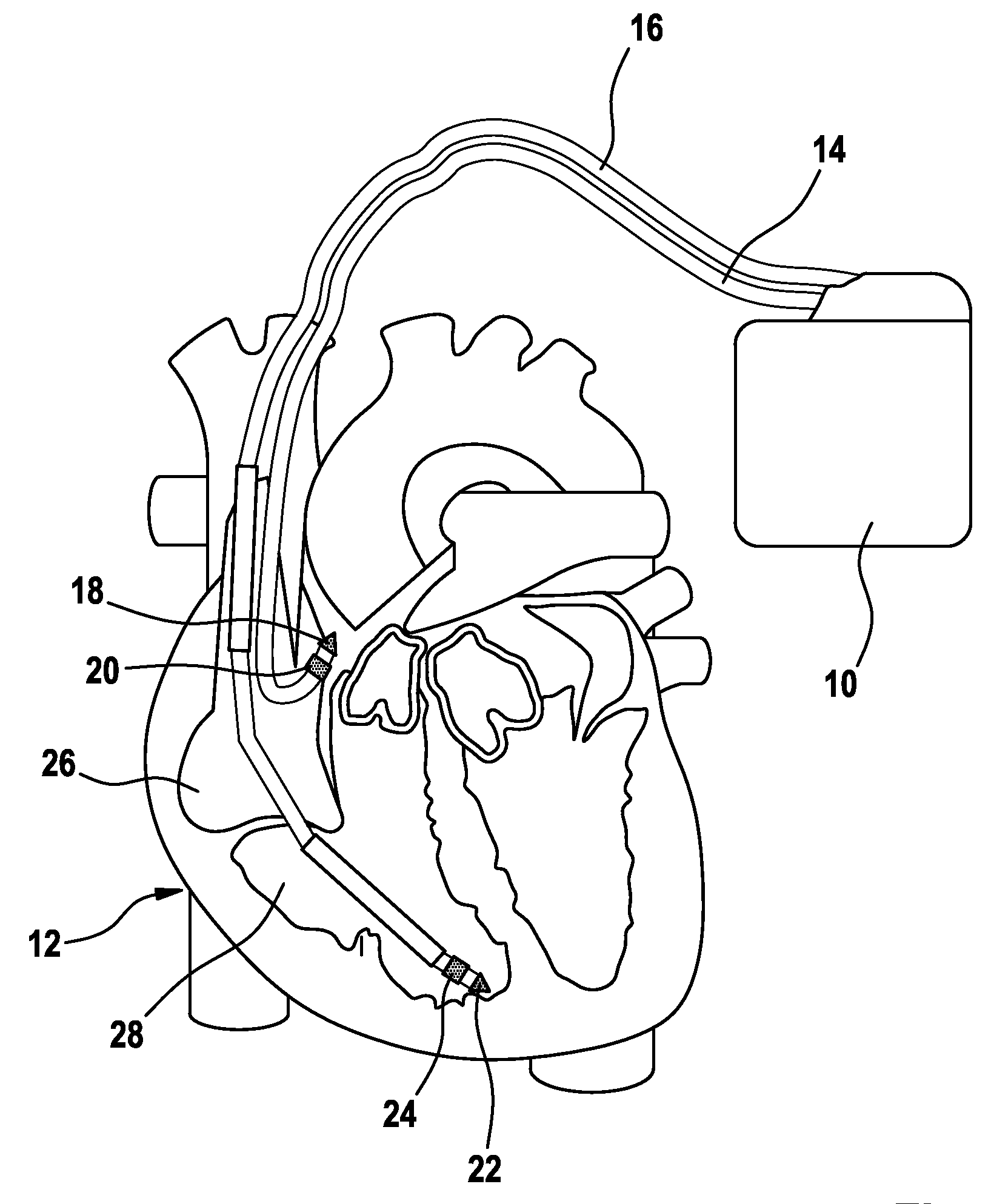 Atrial overdrive pacing in non-atrial tracking mode while maintaining AV synchrony