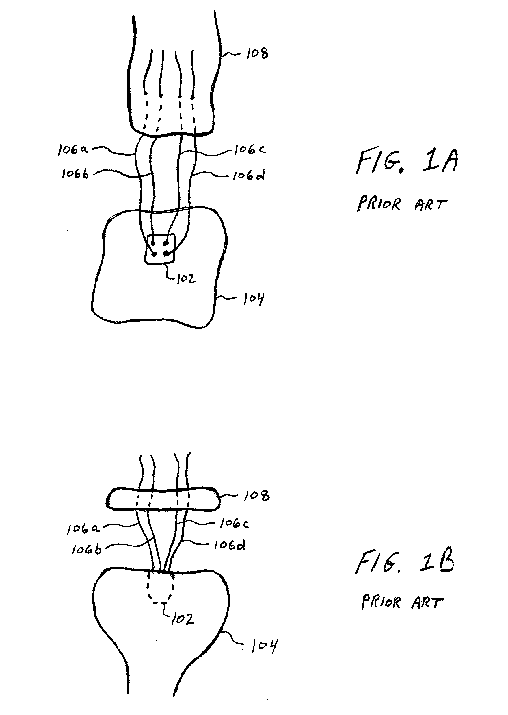 Soft Tissue Fixation Using A Looped Suture Construct