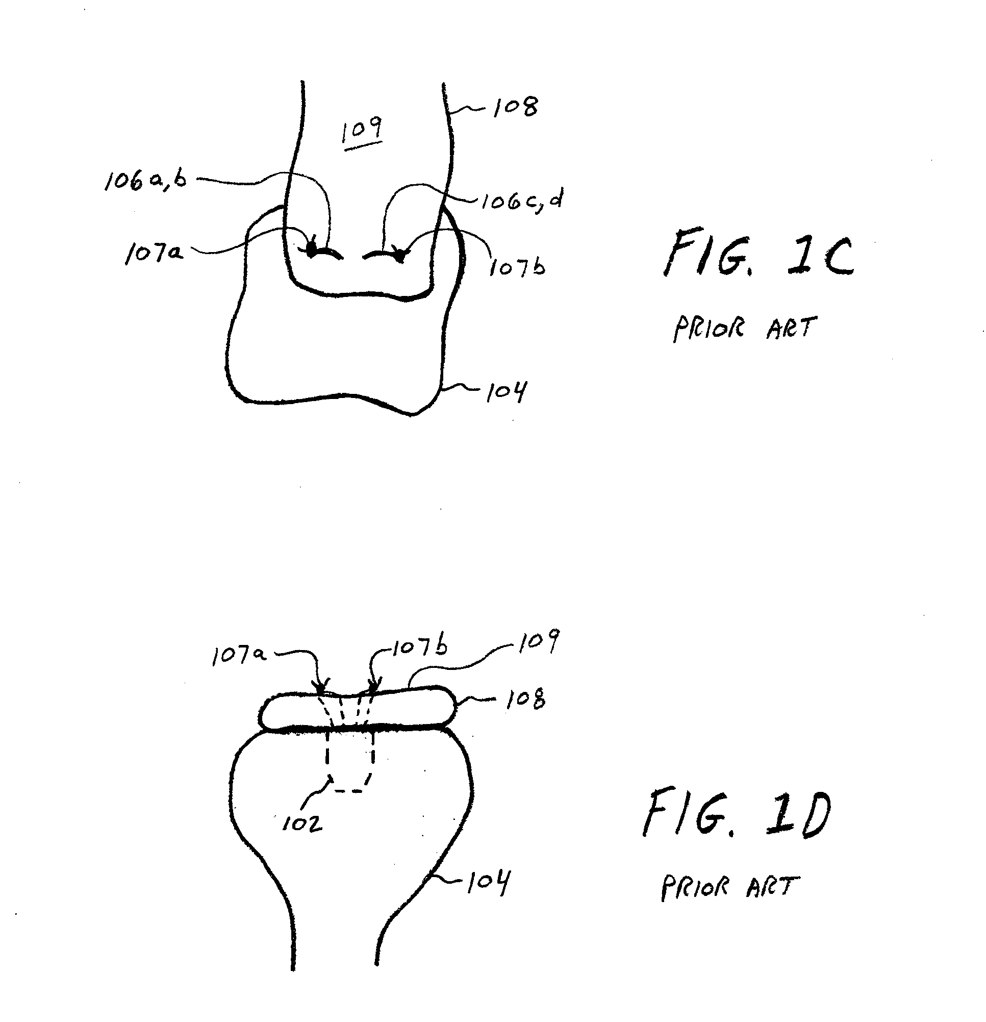 Soft Tissue Fixation Using A Looped Suture Construct