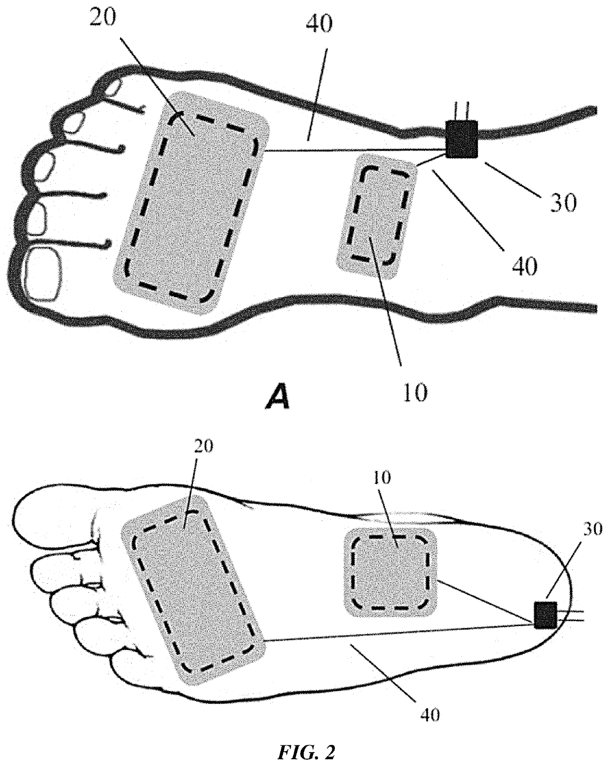 Peripheral Neuromodulation to Treat Bladder and Bowel Dysfunction