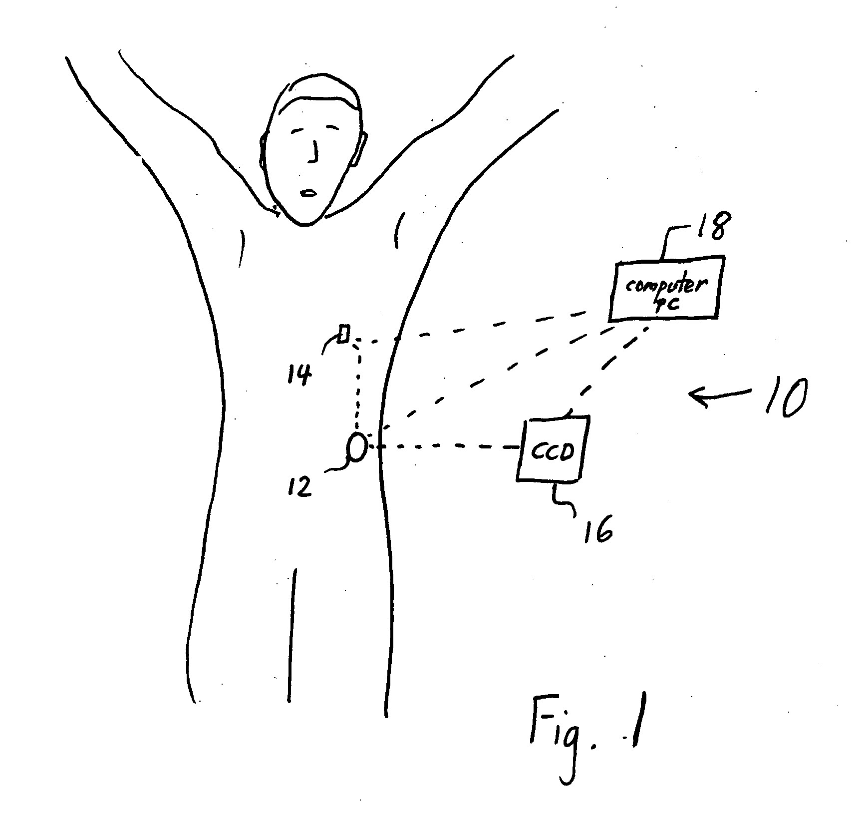 Infusion device and method with disposable portion