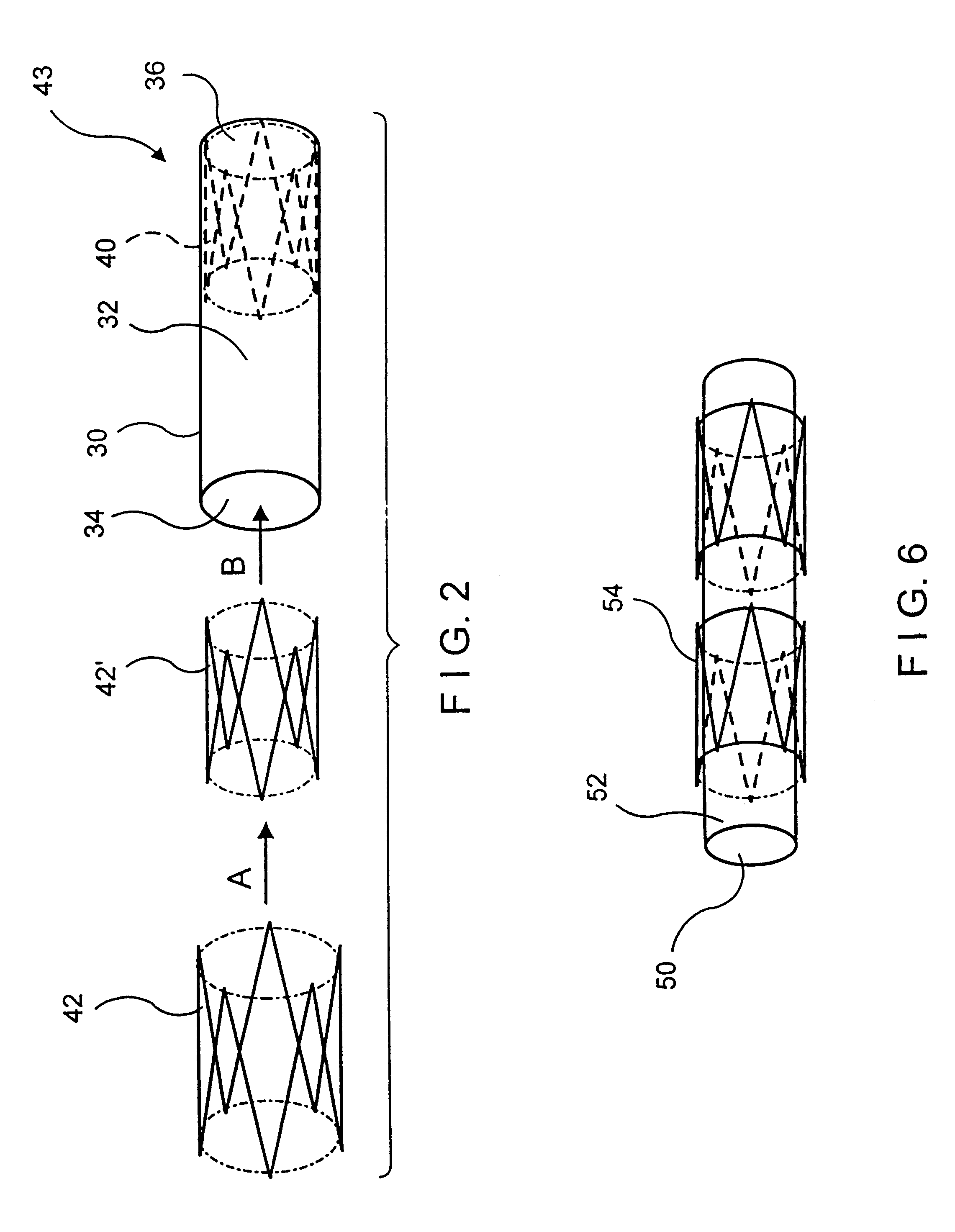 Balloon-assisted intraluminal stent graft