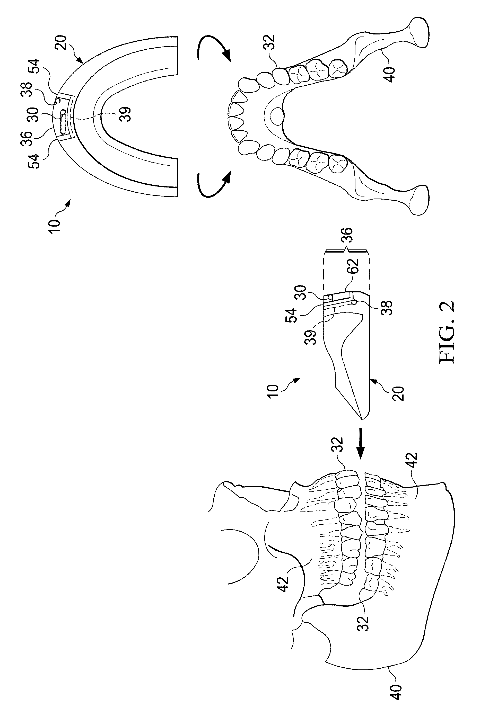 Vibrating orthodontic remodelling device