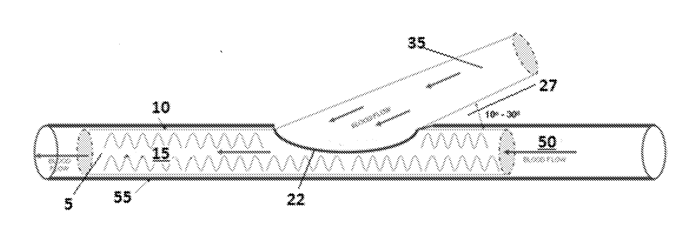 Device and method to prevent or treat outflow vein stenosis of an arteriovenous fistula constructed with a synthetic vascular graft