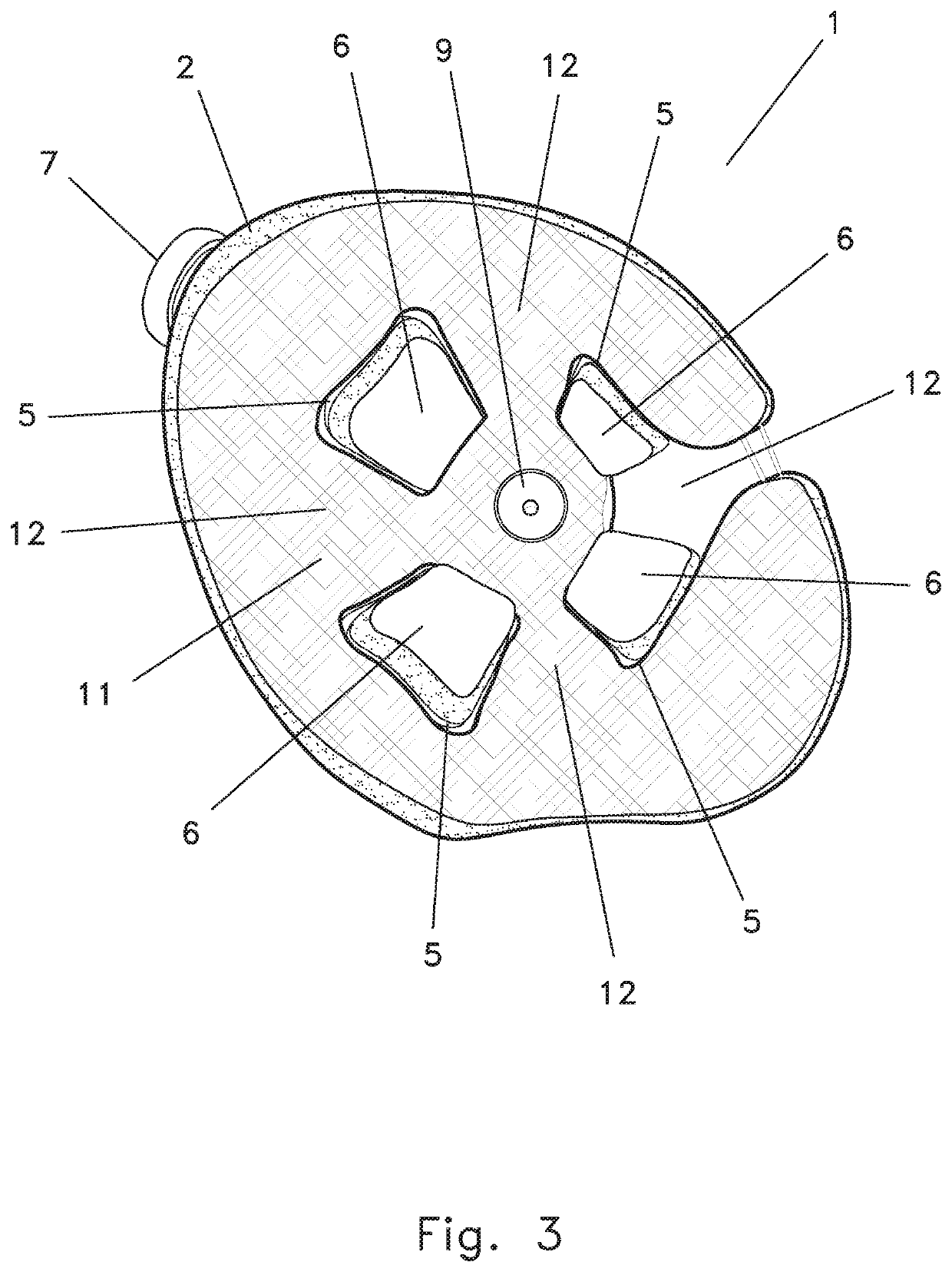 Disarticulated Compression Socket