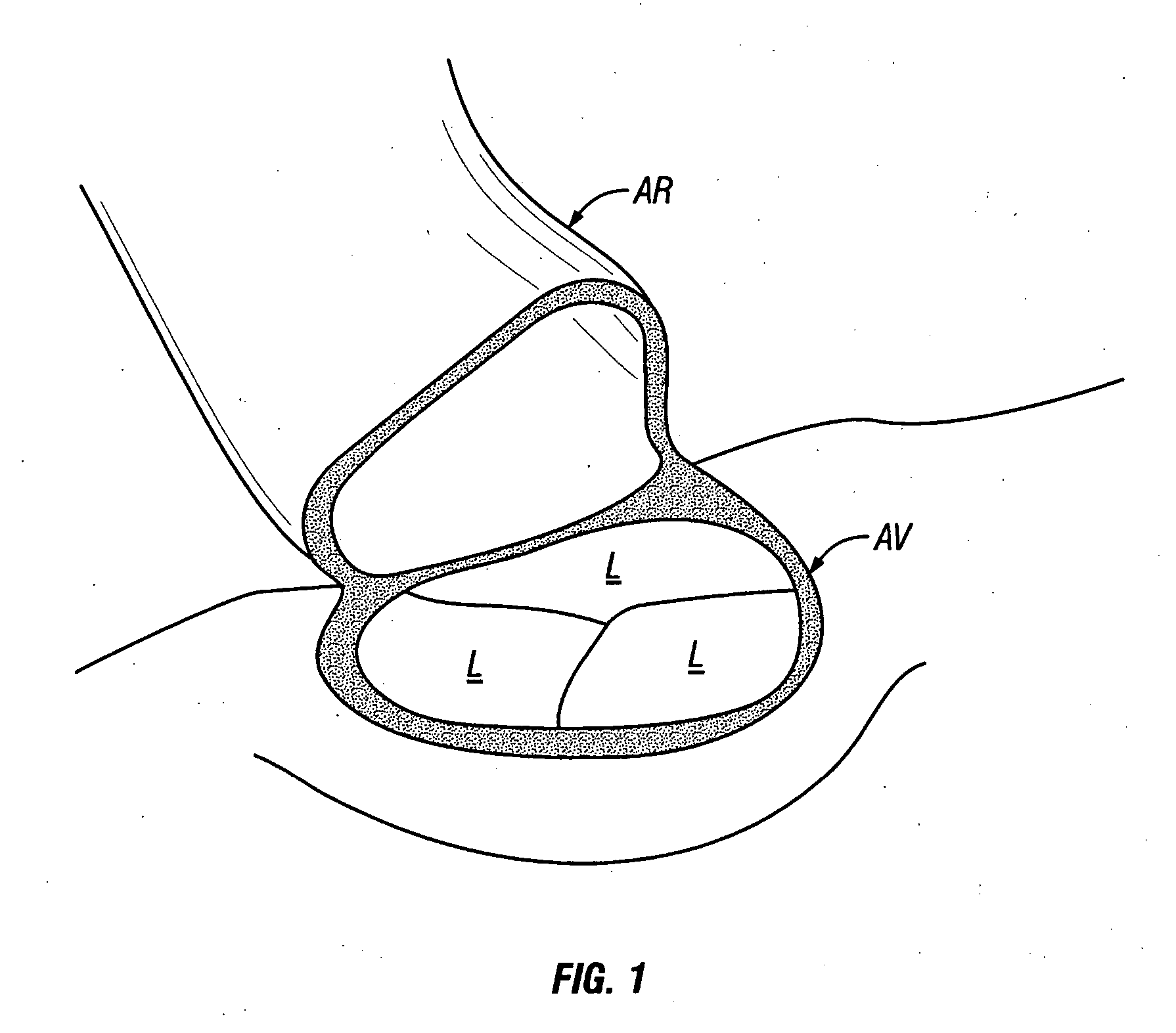 Methods and apparatus for valve repair