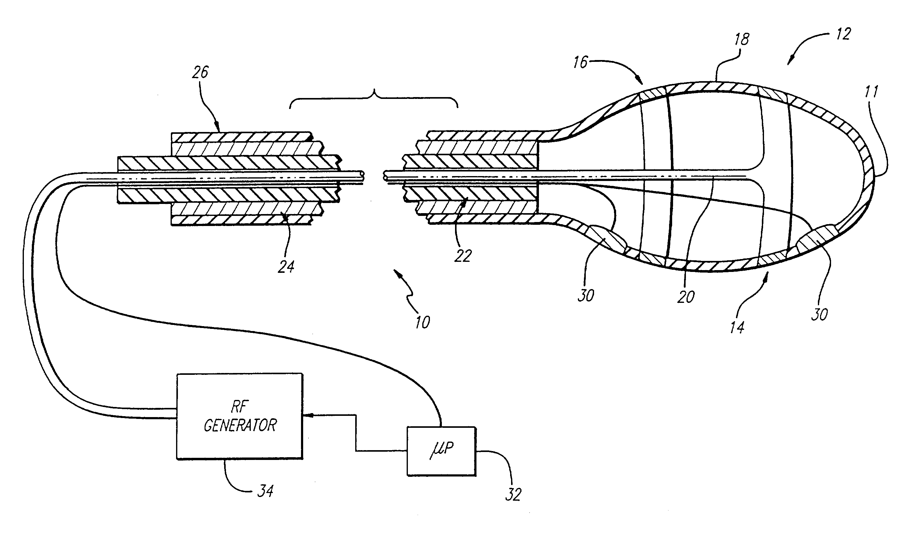 Apparatus for treating venous insufficiency