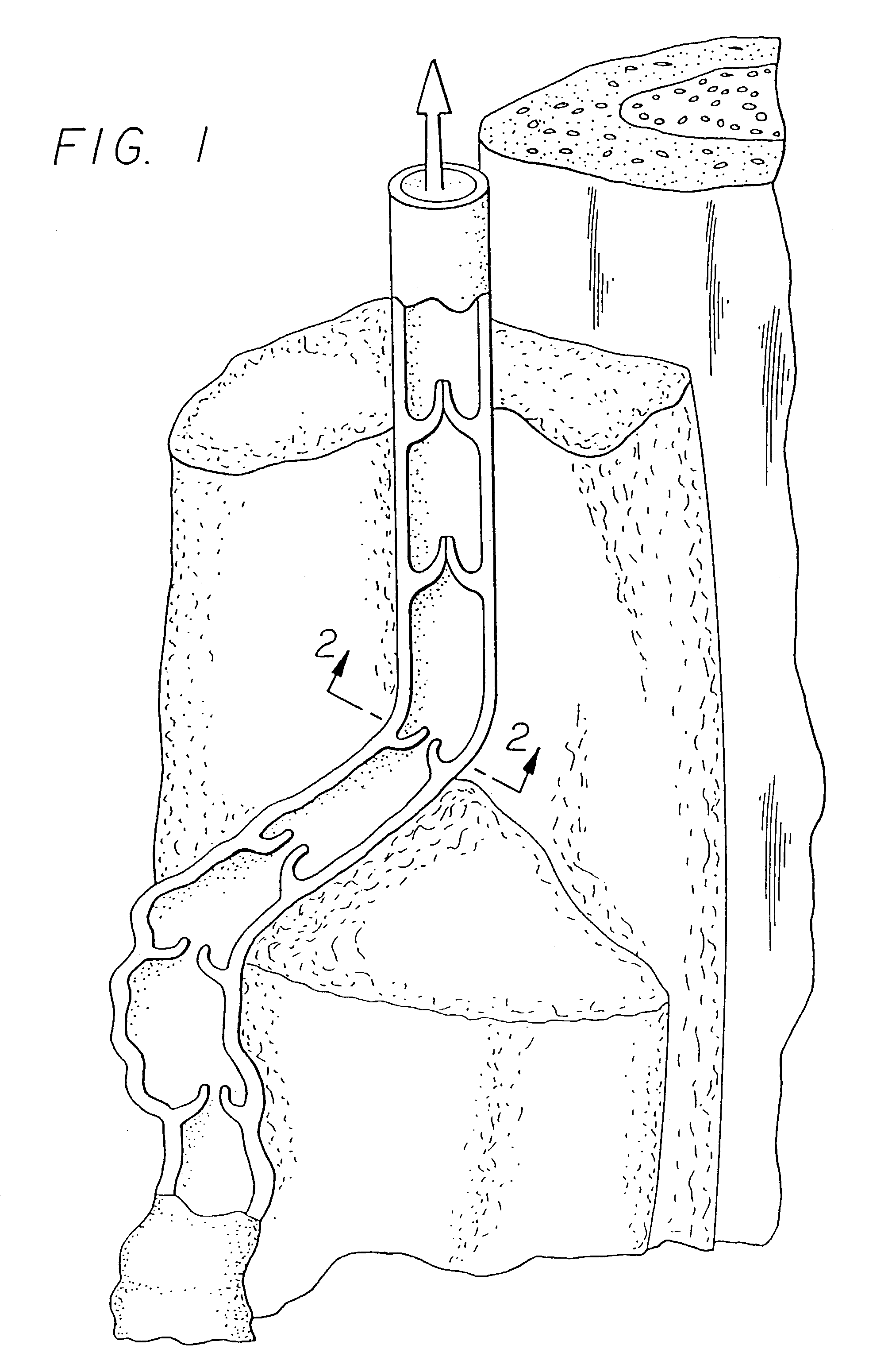 Apparatus for treating venous insufficiency