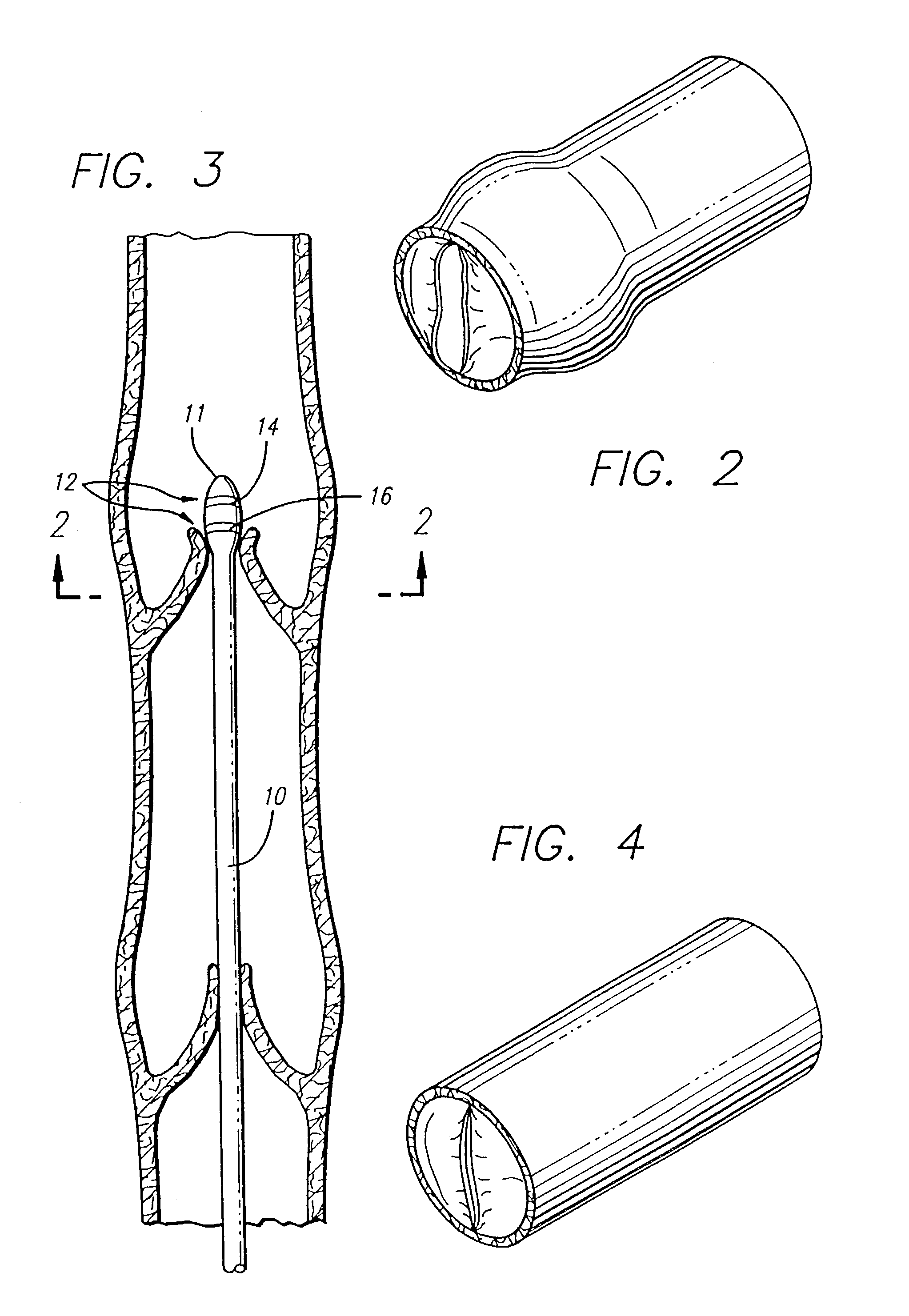 Apparatus for treating venous insufficiency