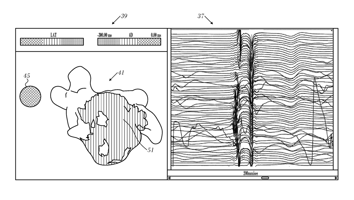 Ventricular electrical activity indicator