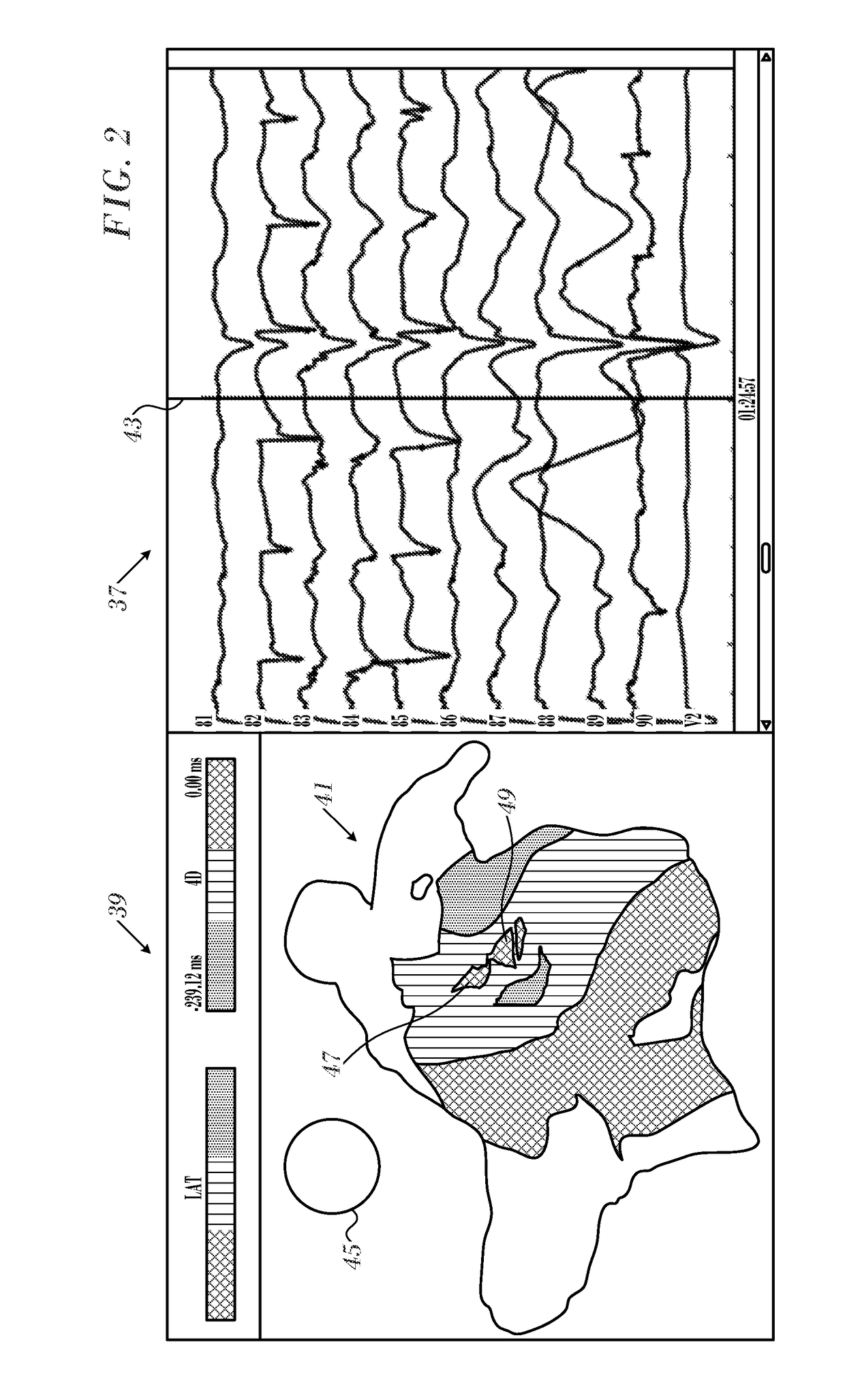 Ventricular electrical activity indicator