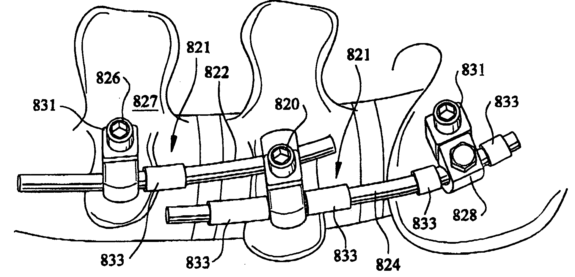 Artificial facet joint and method