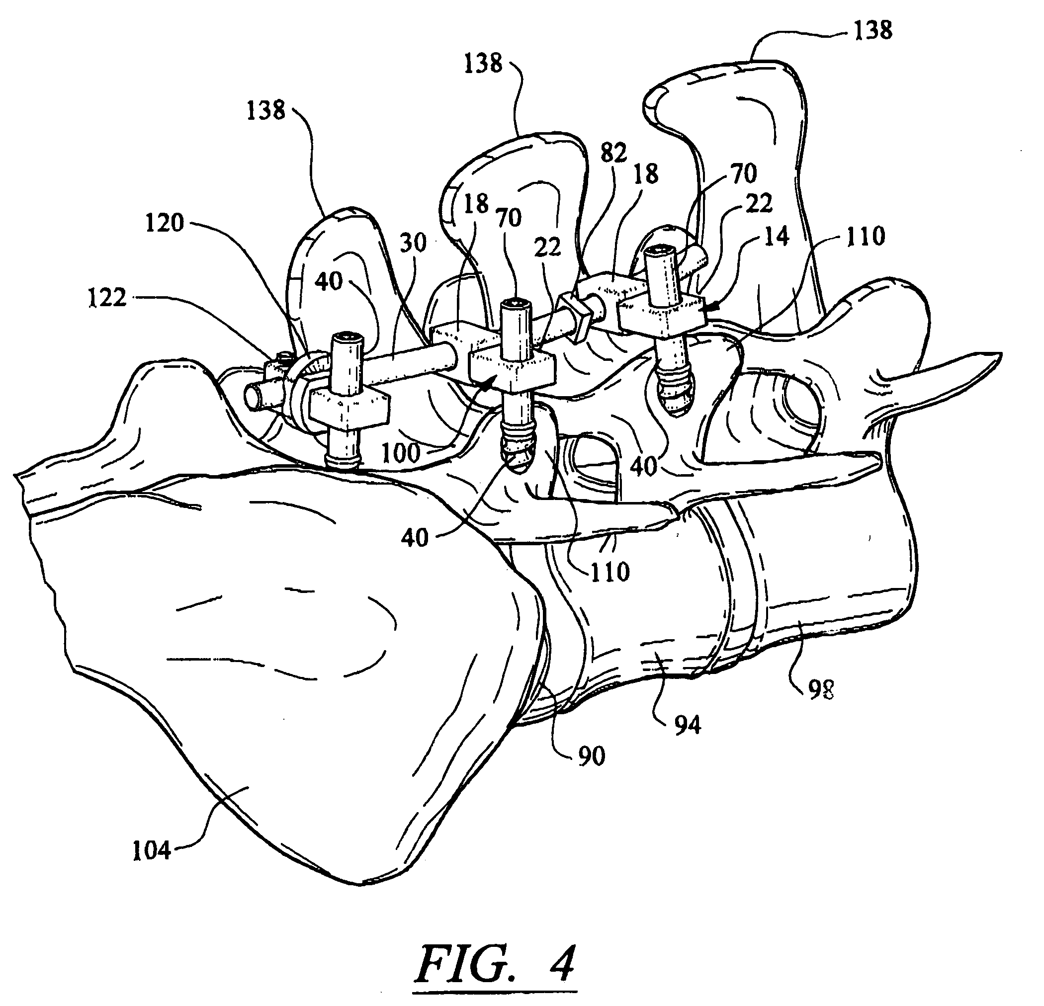 Artificial facet joint and method