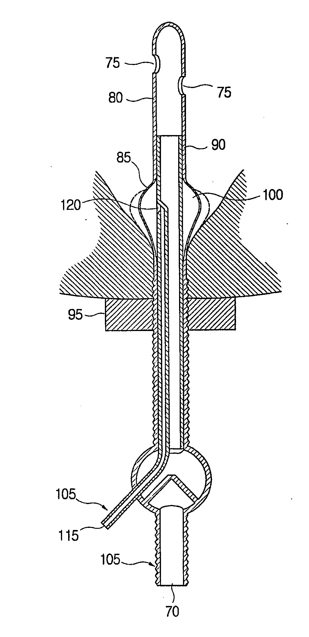 Indwelling urinary catheter