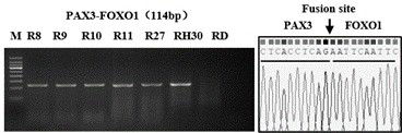 Rhabdomyosarcoma Fusion Gene Related Circular RNA Molecular Marker and Its Application