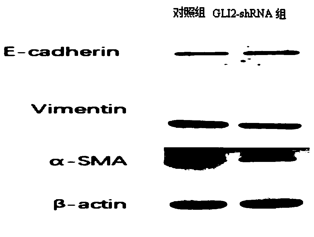 GLI2-shRNA and application thereof