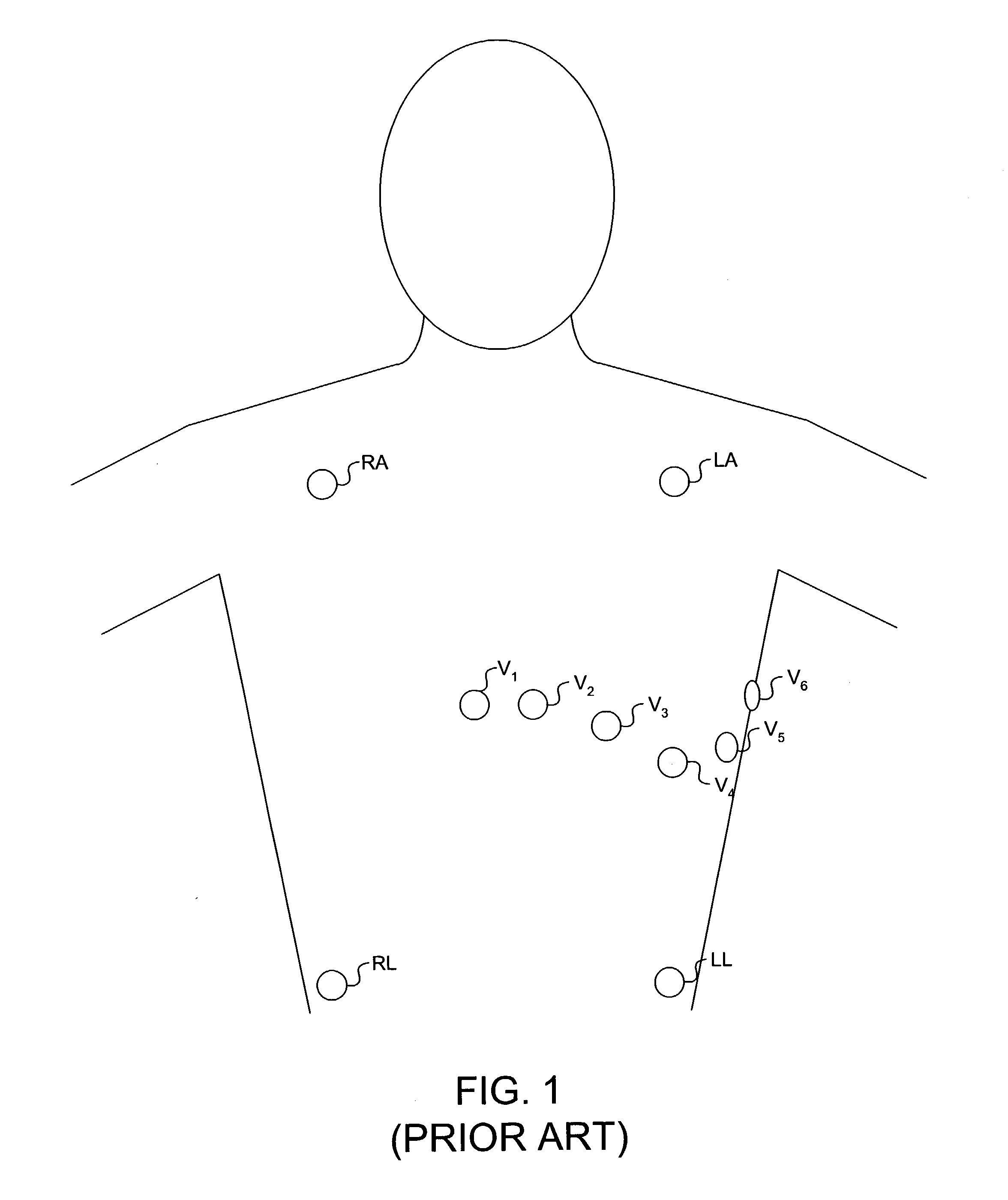 System and method for emulating a surface EKG using an implantable cardiac stimulation device