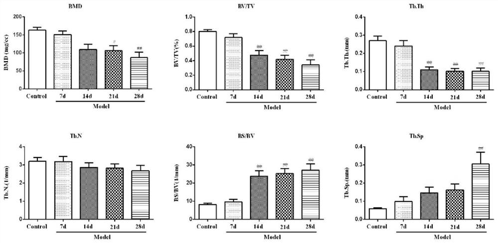 A diagnostic marker for bone destructive diseases and its application