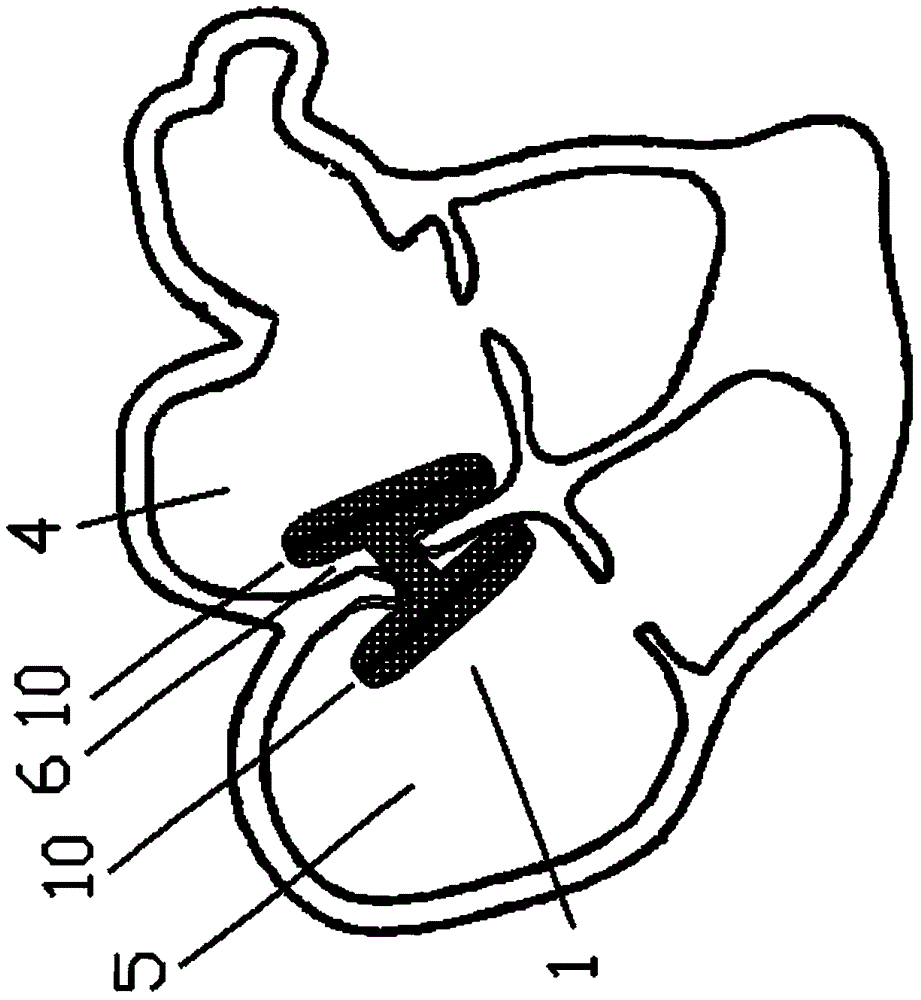 Closure device