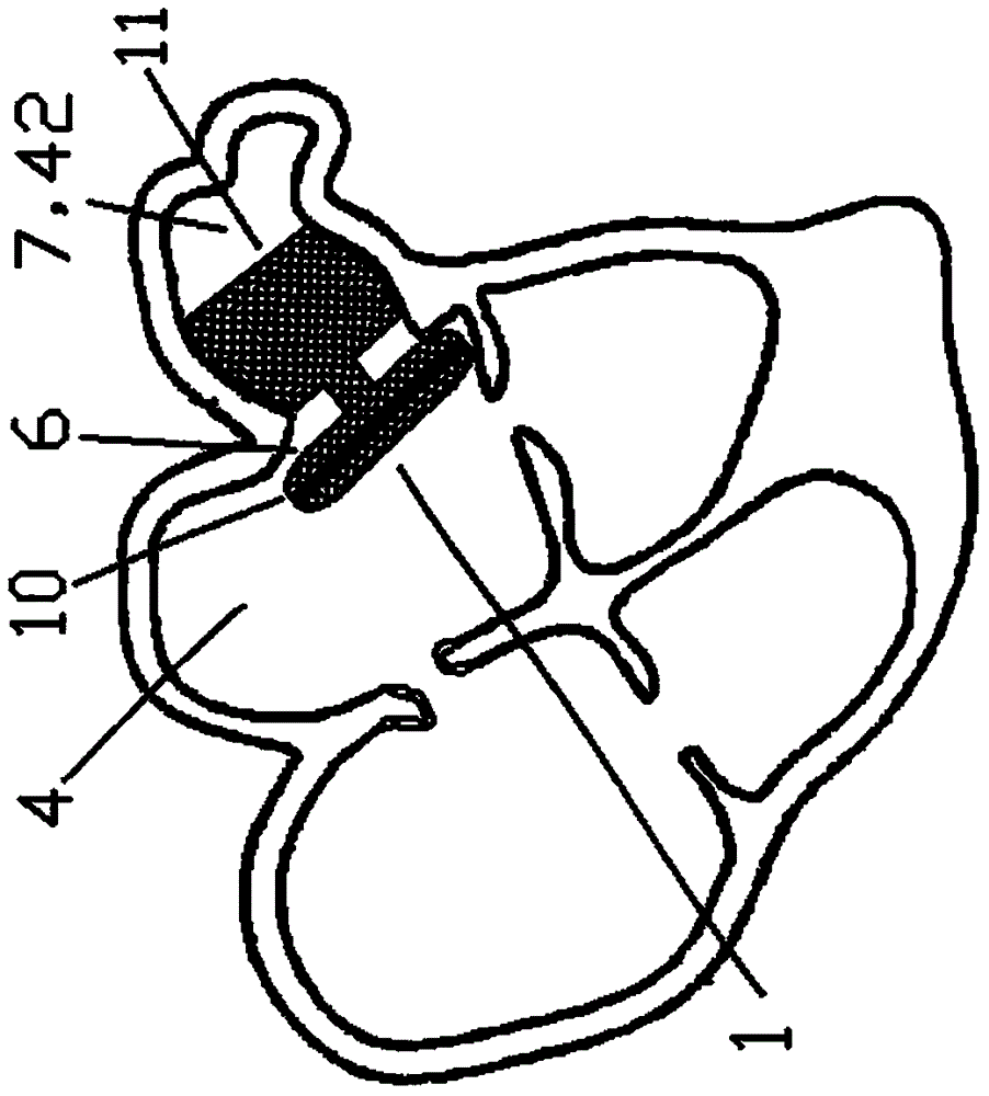 Closure device