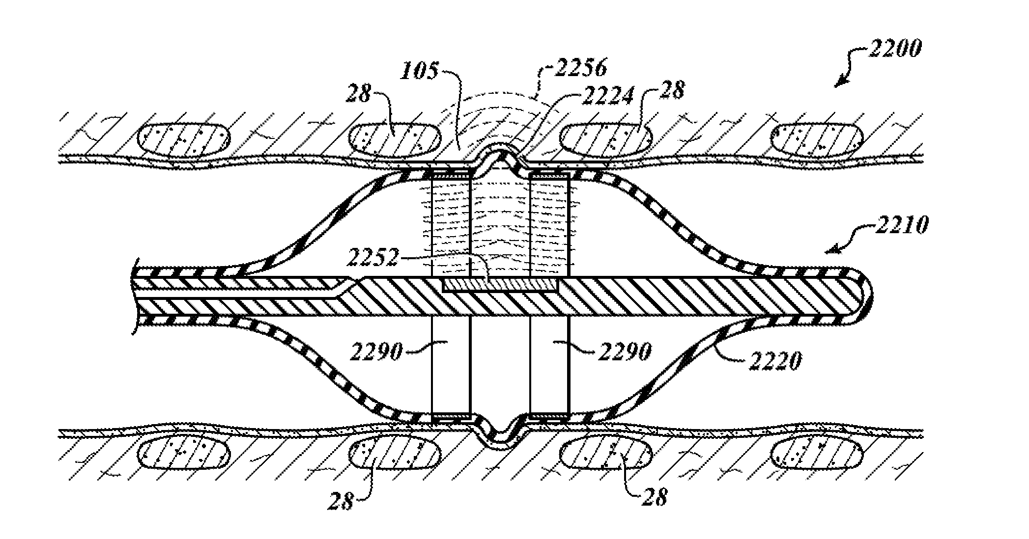 Systems, devices, and methods for treating a pulmonary disease with ultrasound energy