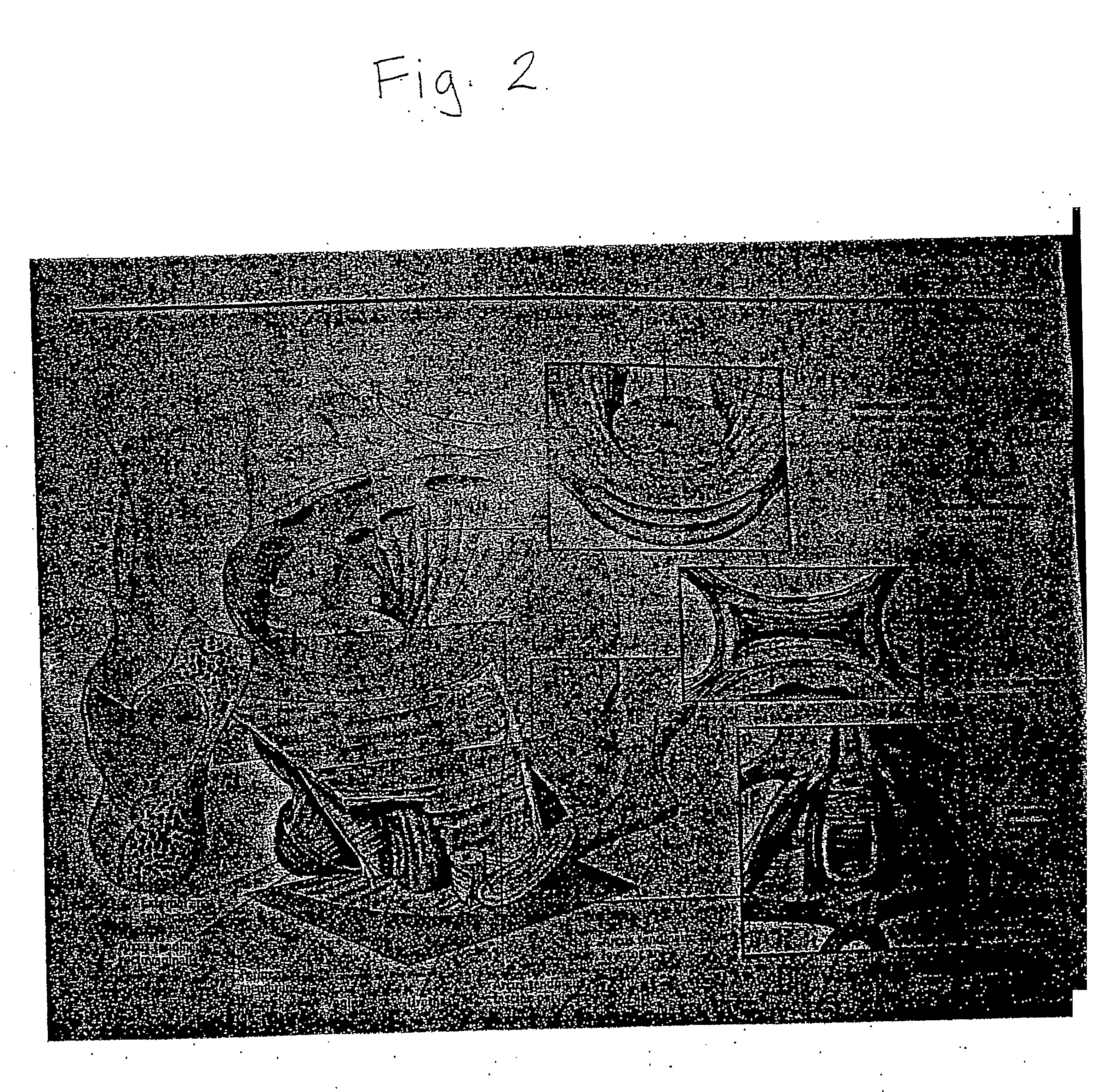 Apparatus for Posterior Pelvic Floor Repair