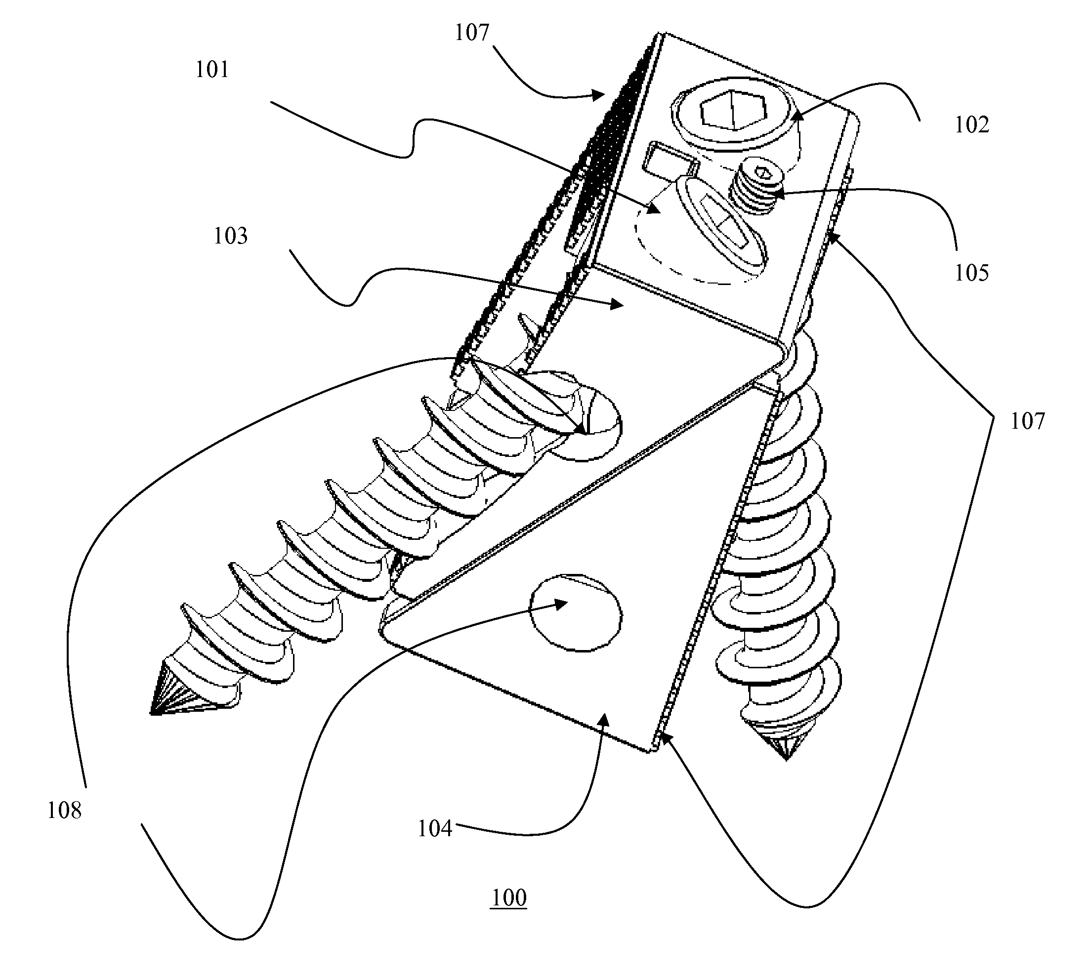 Bi-directional fixating transvertebral body screws and posterior cervical and lumbar interarticulating joint calibrated stapling devices for spinal fusion