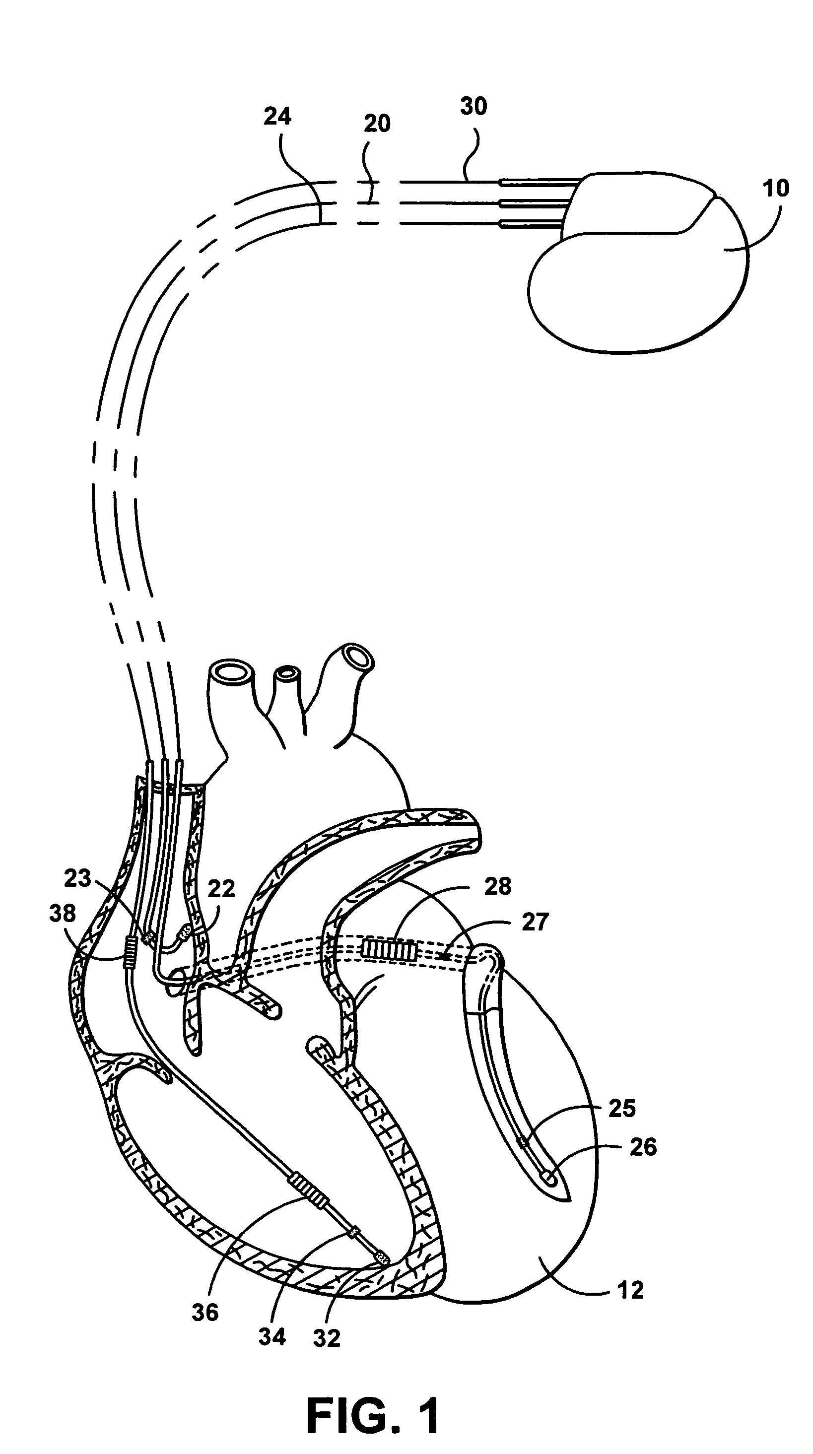 Multi-site cardiac stimulation device and method for detecting retrograde conduction