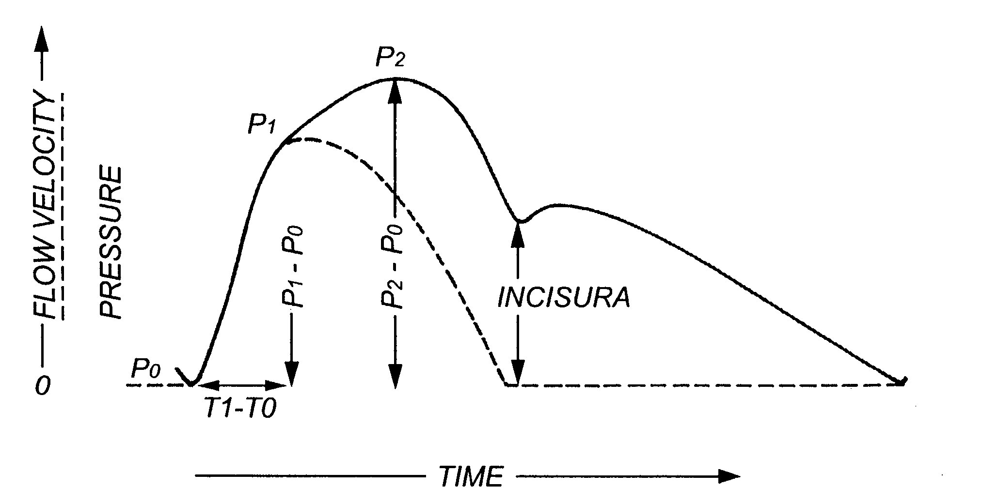 Method and apparatus for determination of cardiac output from the arterial pressure pulse waveform