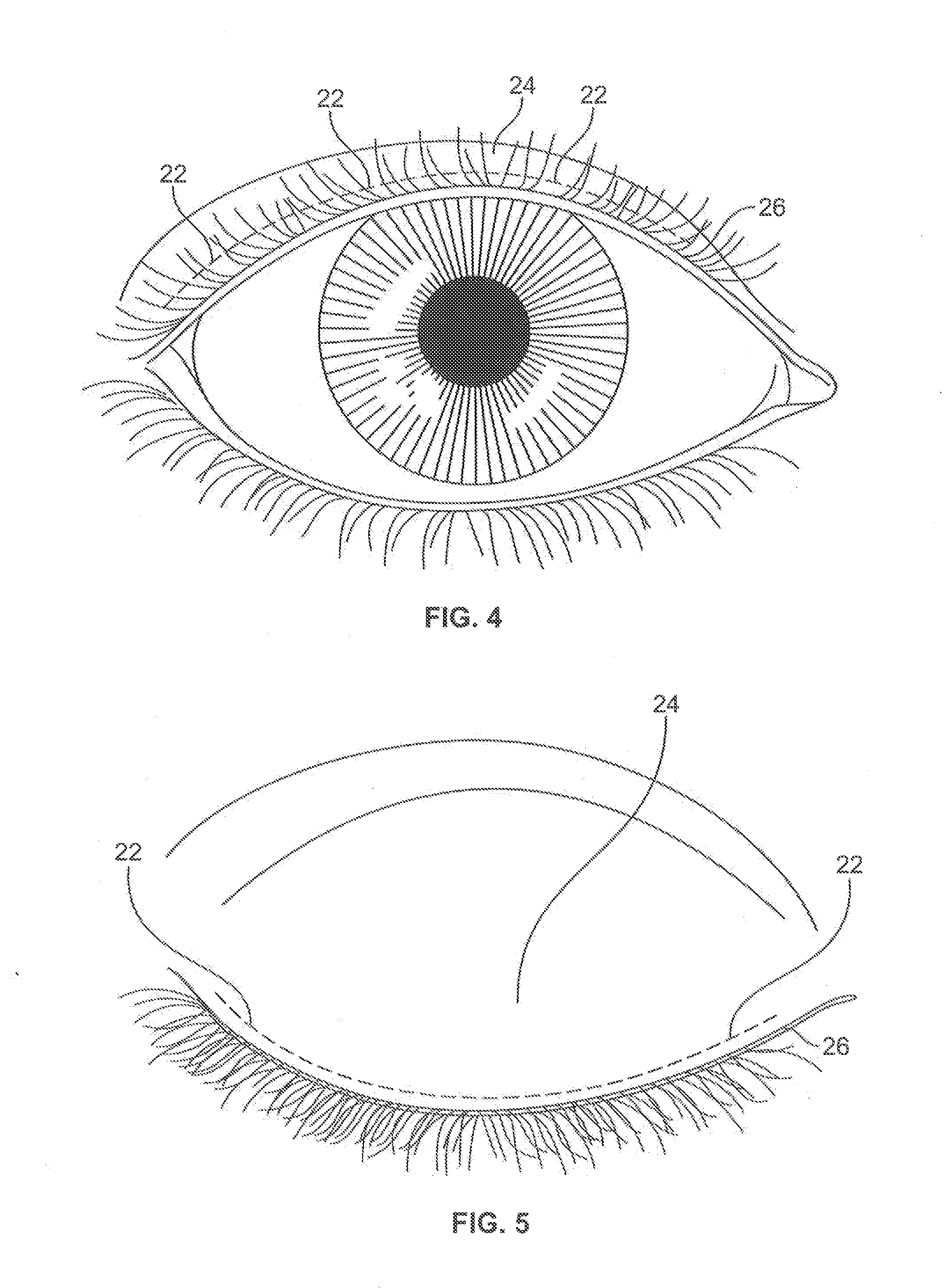 Ciliary Implant, Ciliary Augmentation