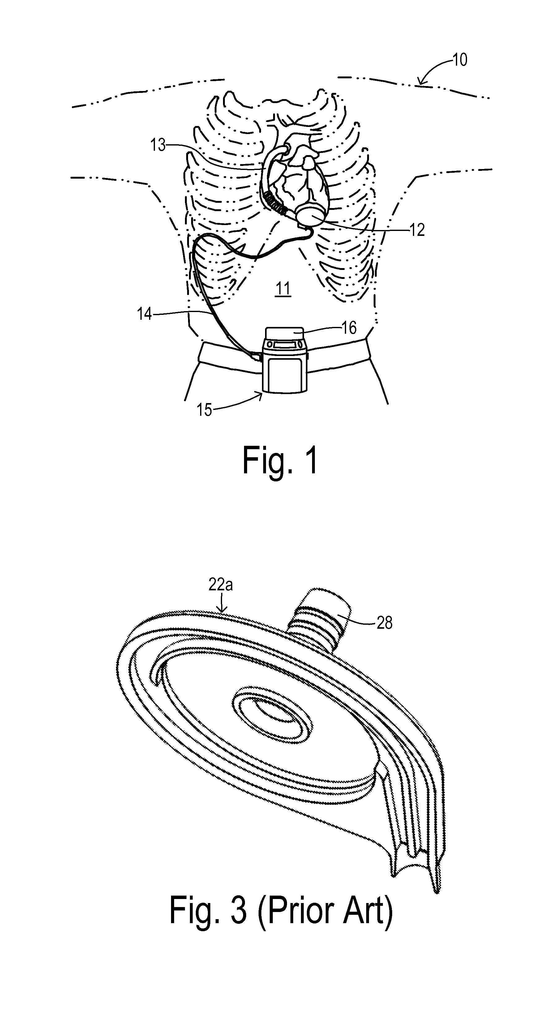 Backflow detection for centrifugal blood pump