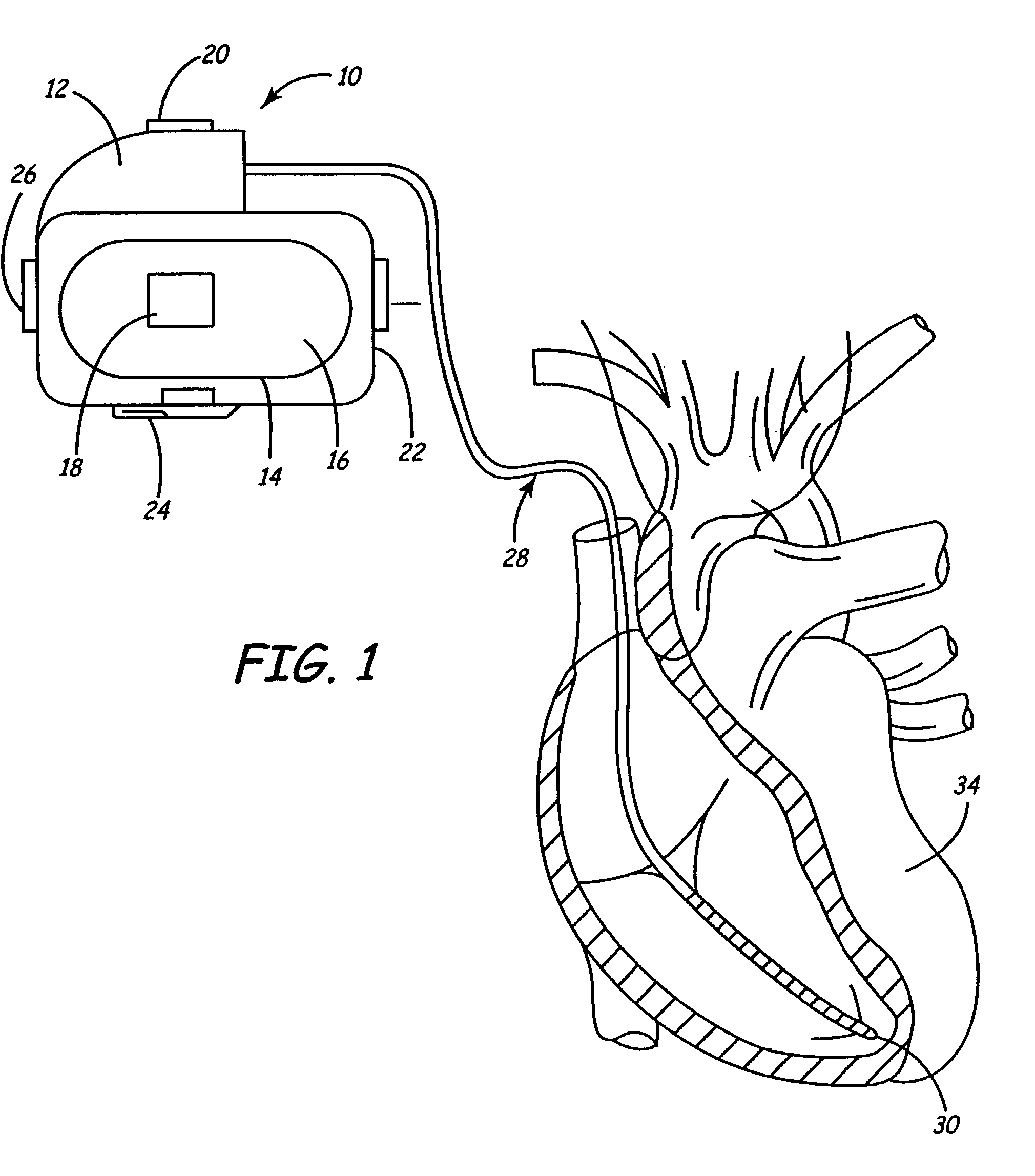 Ischemia detection