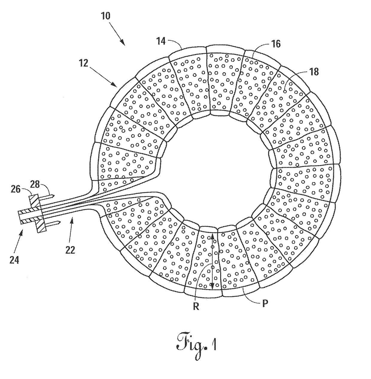 Radially Expandable Annulus Reinforcement Prosthesis