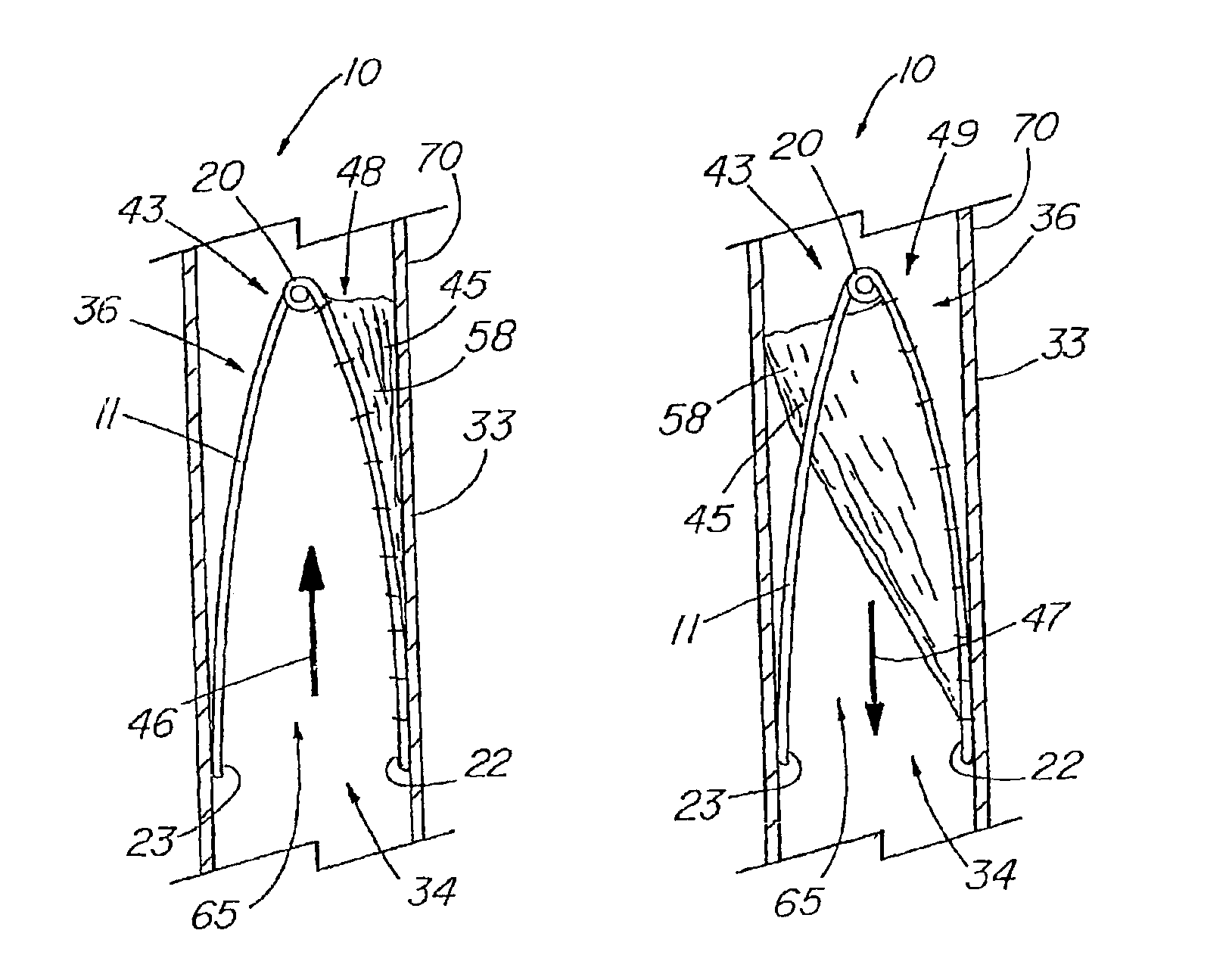 Multiple-sided intraluminal medical device