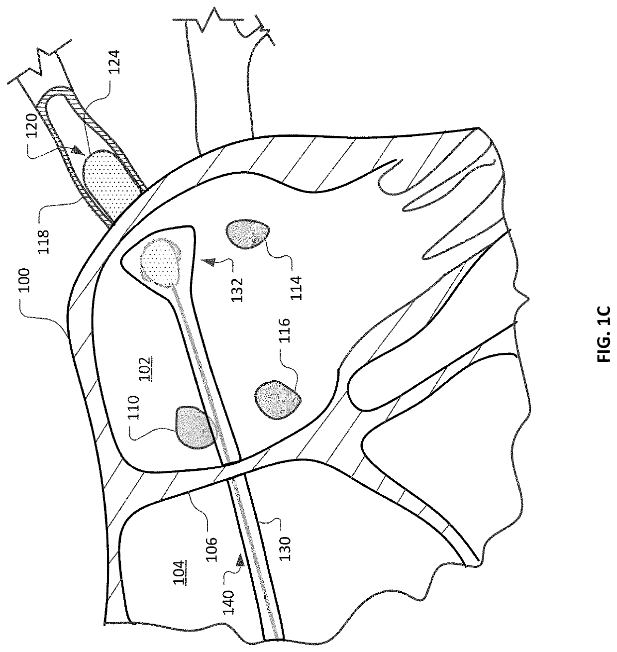 Devices and methods for ablation of tissue