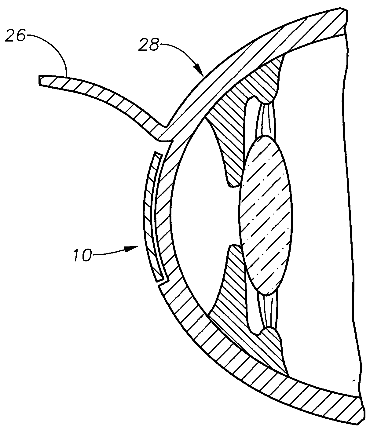 Aspheric lenticule for keratophakia