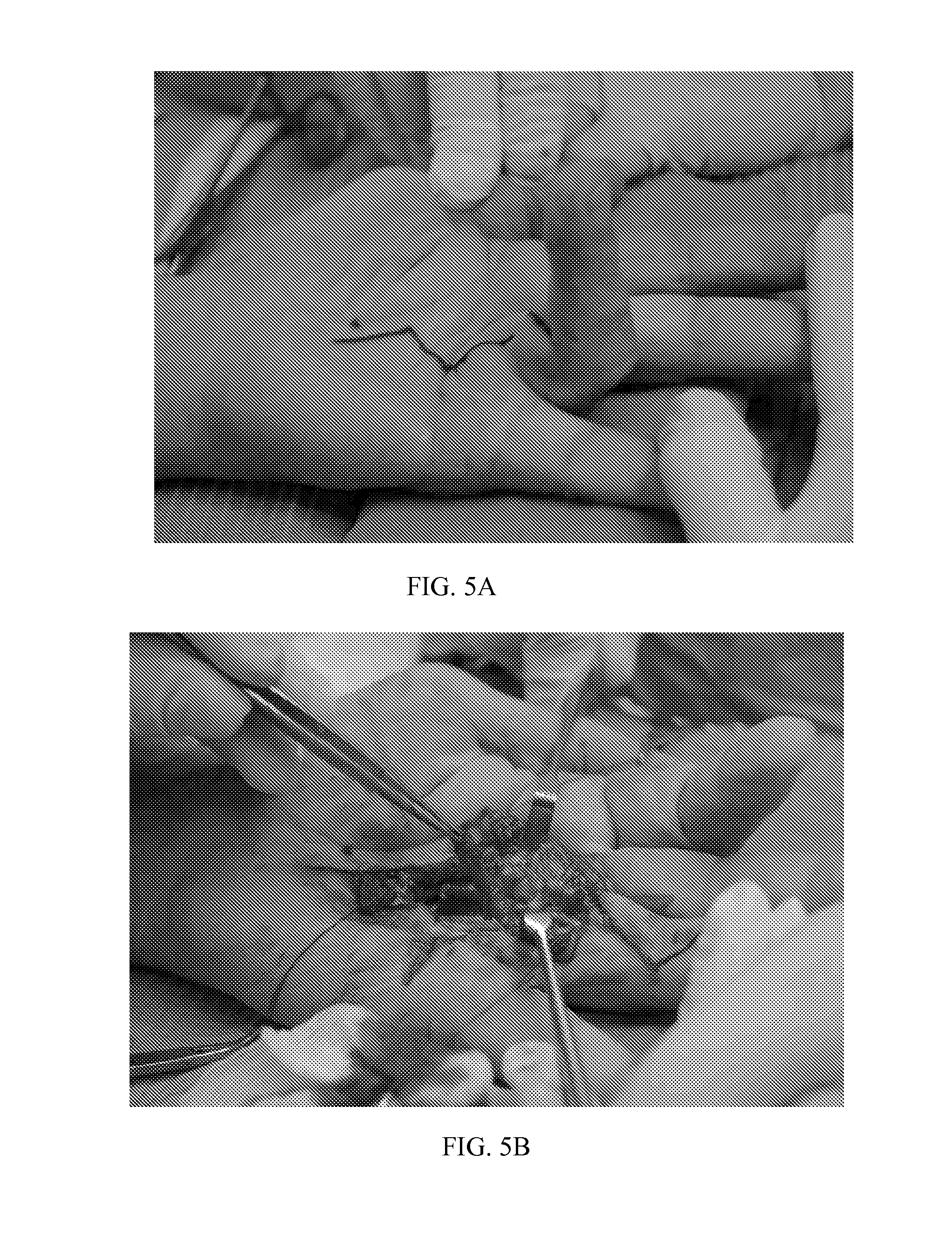 Proteolytic extract from bromelain for the treatment of connective tissue disorders