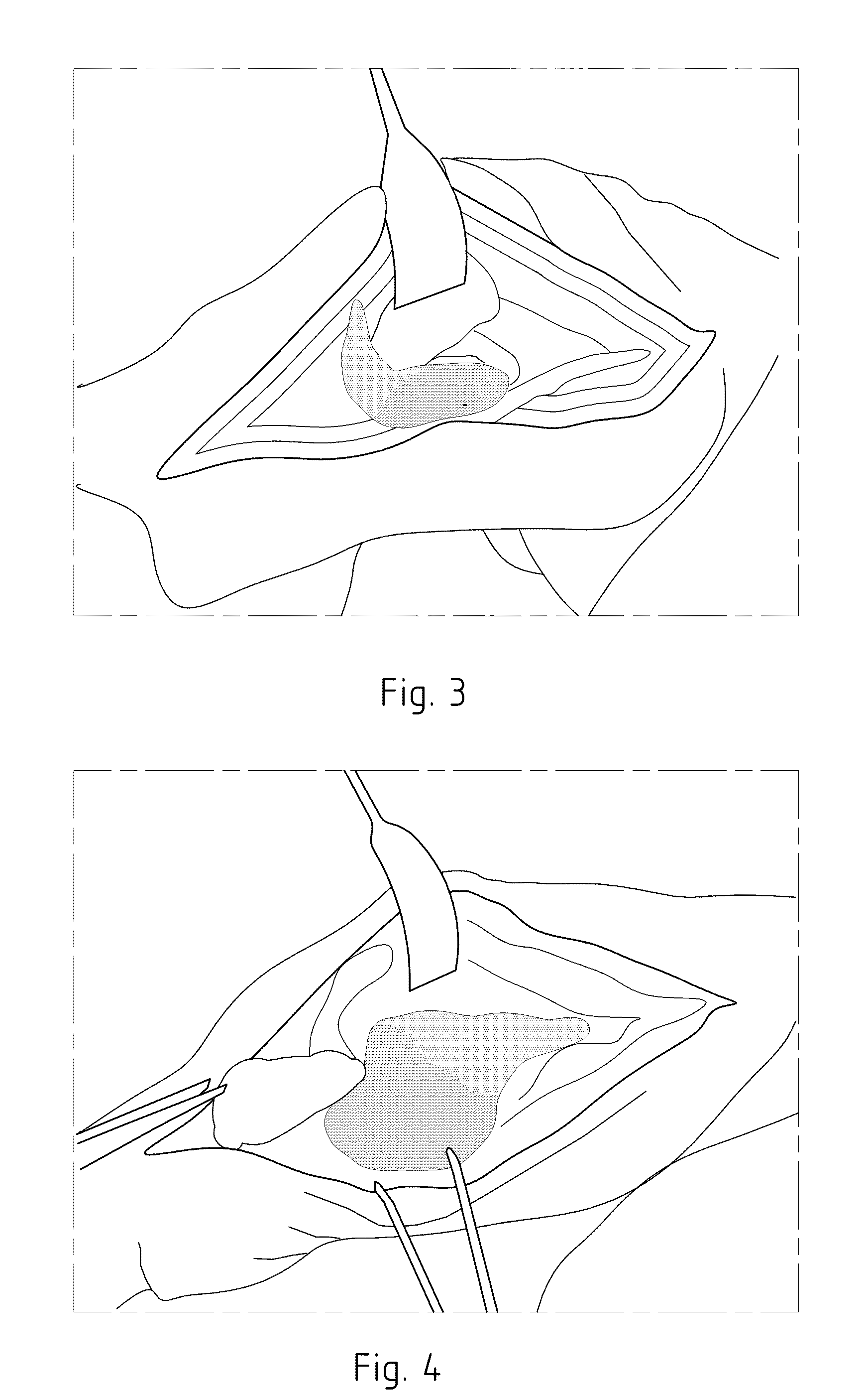 Instruments for carrying out an operating procedure on a joint