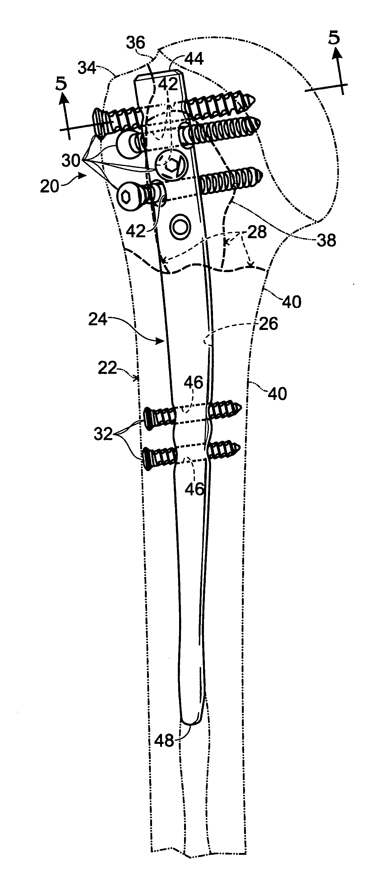 Orthopedic rod with locking aperture