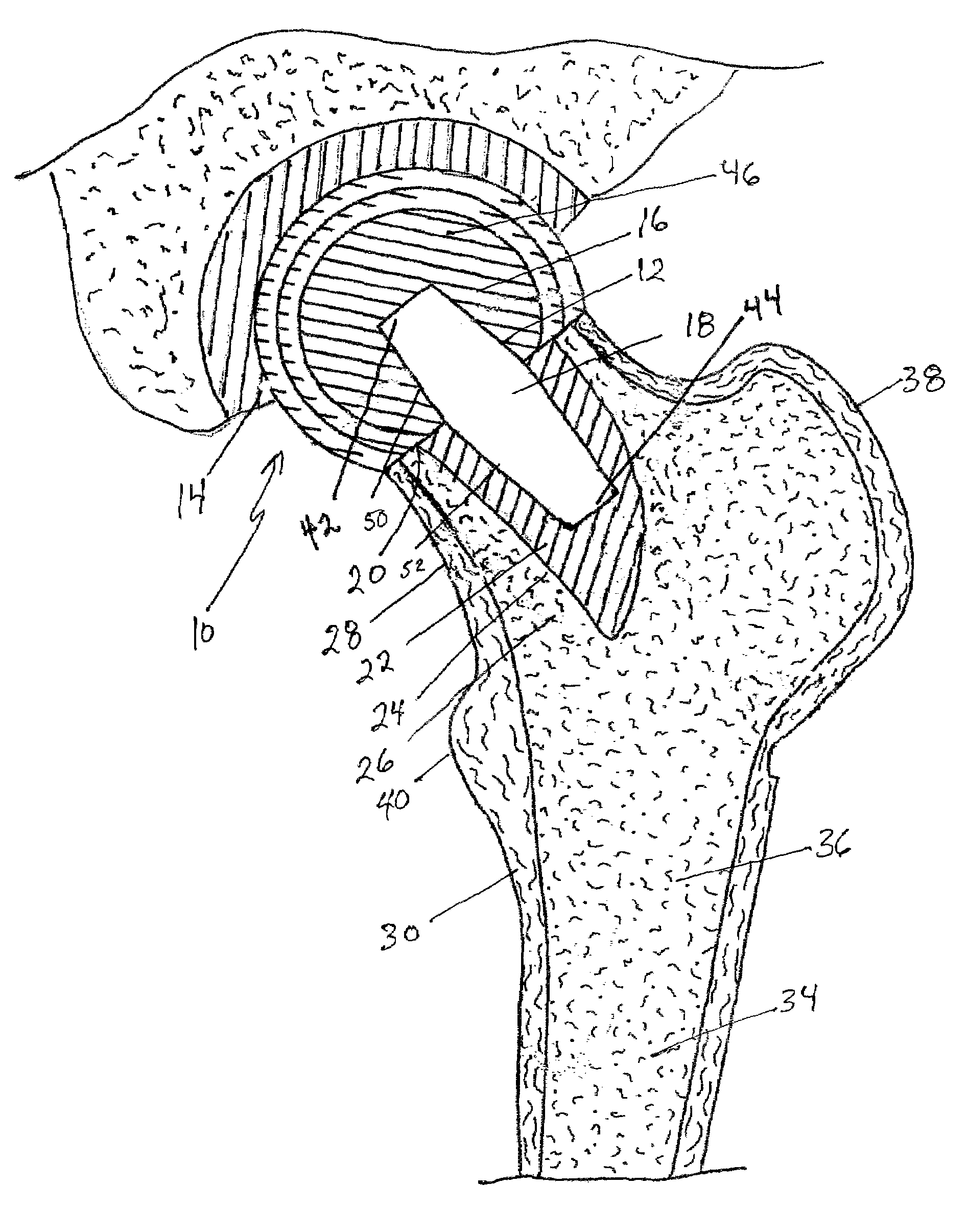 Femoral head calcar loading prosthesis