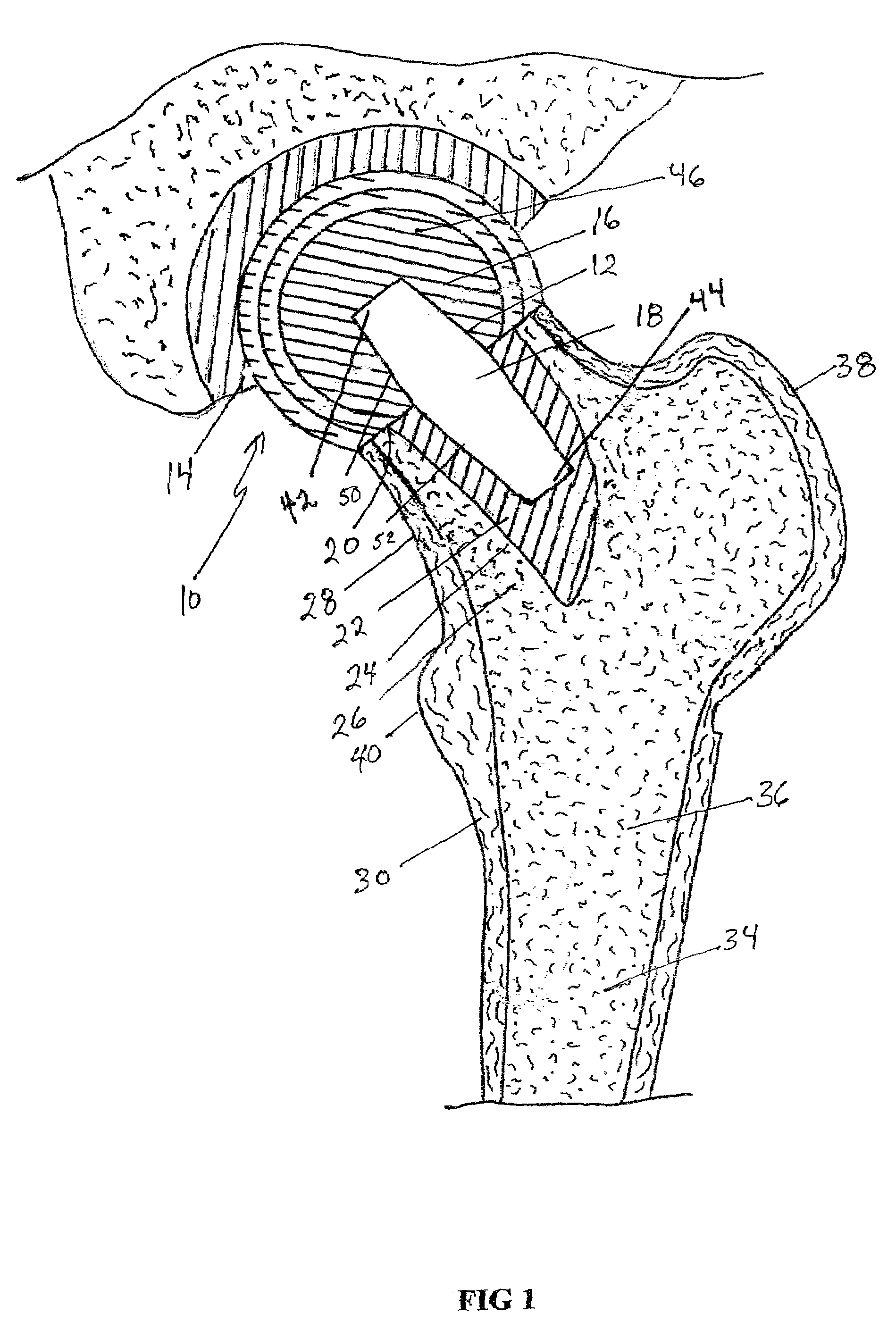 Femoral head calcar loading prosthesis